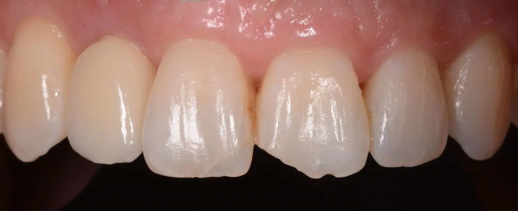 Aesthetic Restorations