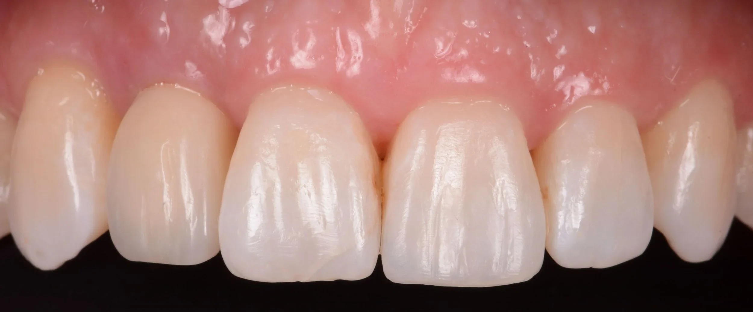 Aesthetic Restorations