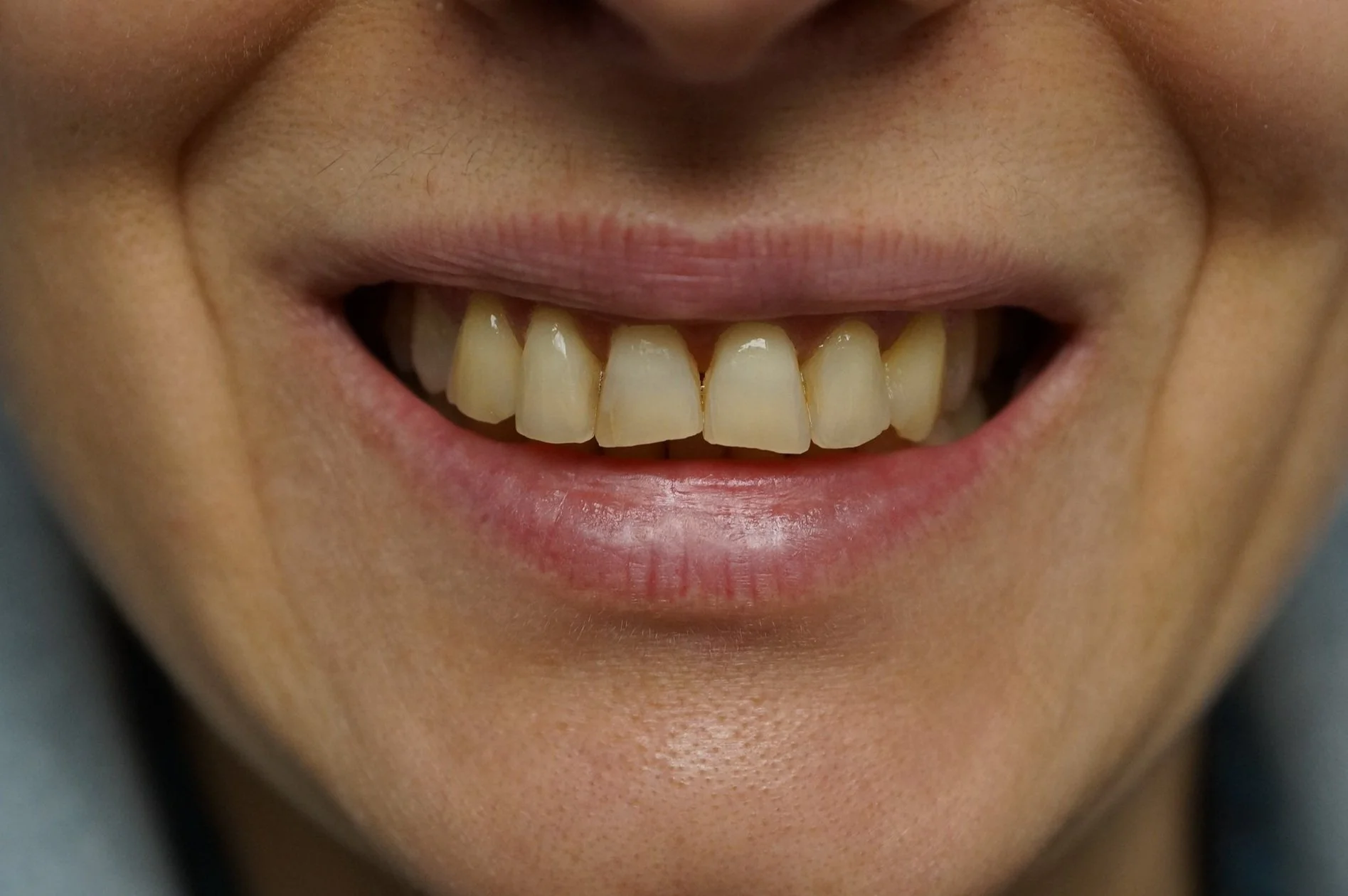 Before - Philips Zoom Whitening & 6 front composite veneers