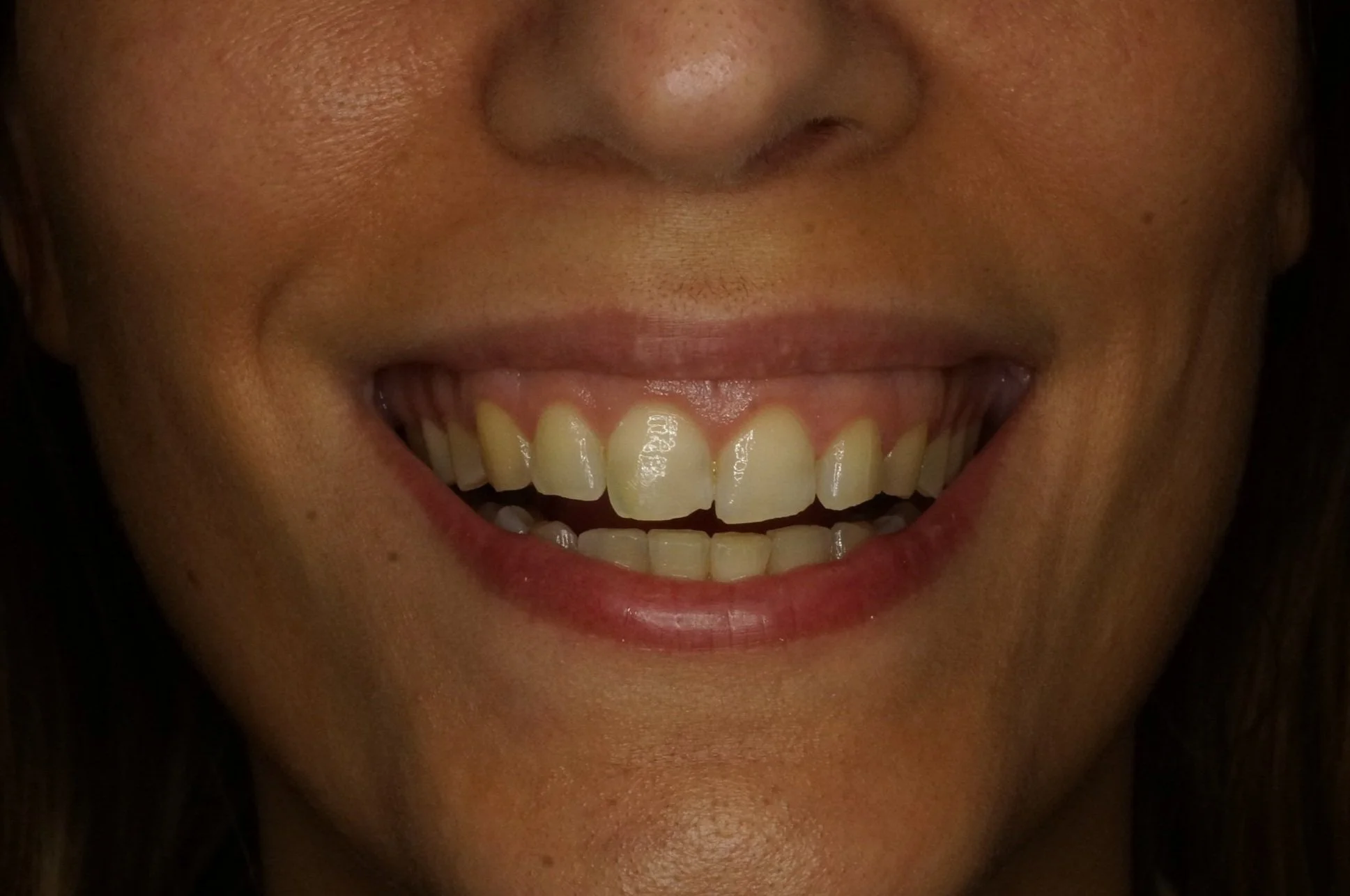 Before - Philips Zoom Whitening and Gingivoplasty front aesthetic composite restorations 