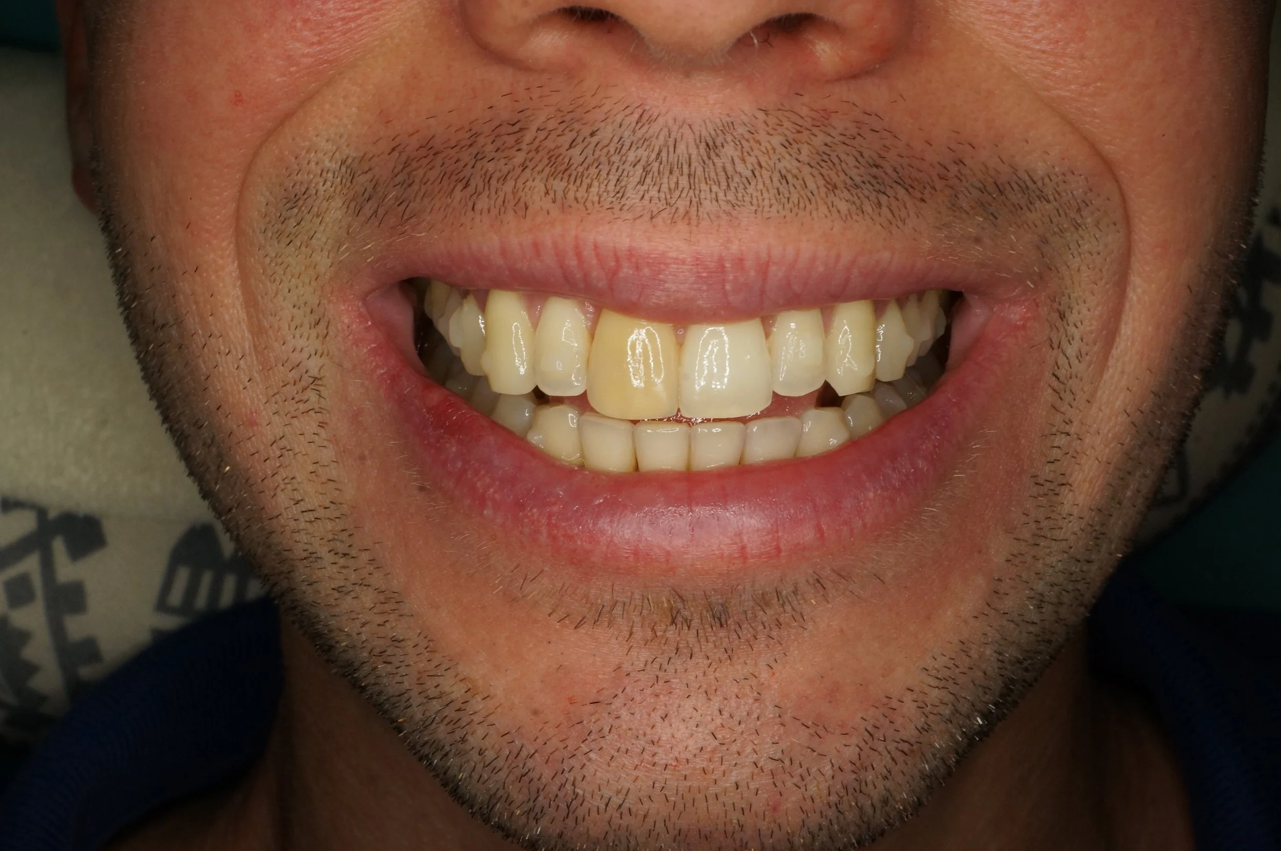 Before - Philips Zoom Whitening & 2 lateral incisors aesthetic reconstructions (no internal whitening)