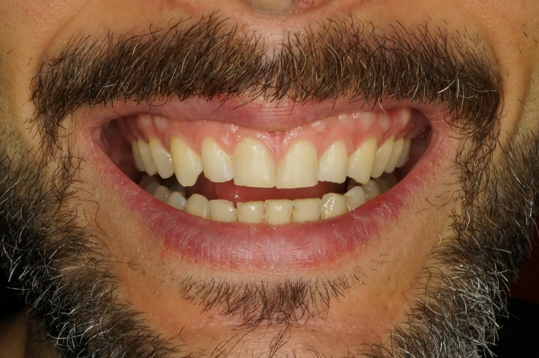 Before - Philips Zoom Whitening & 4 front composite veneers