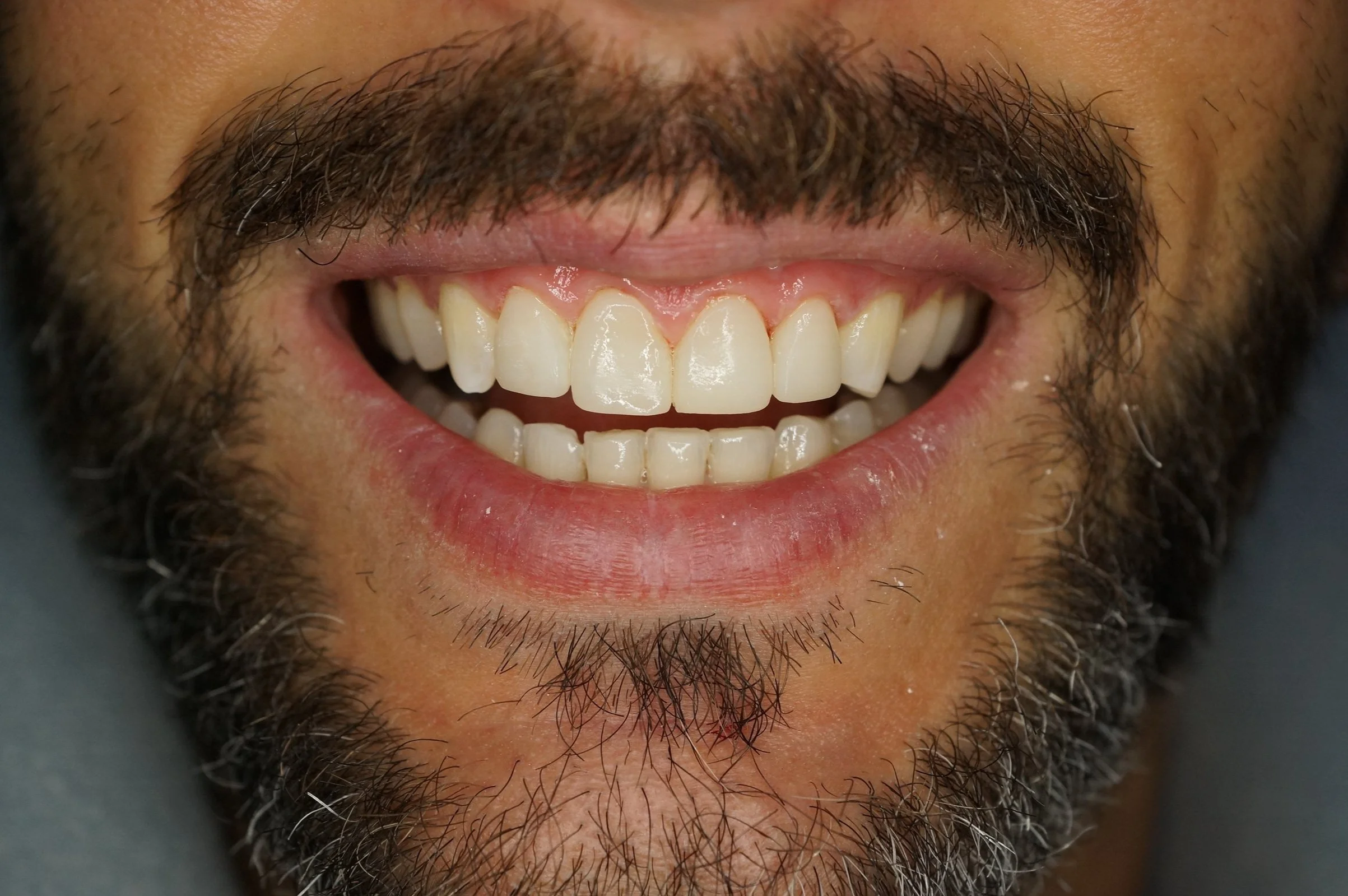 After - Philips Zoom Whitening & 4 front composite veneers