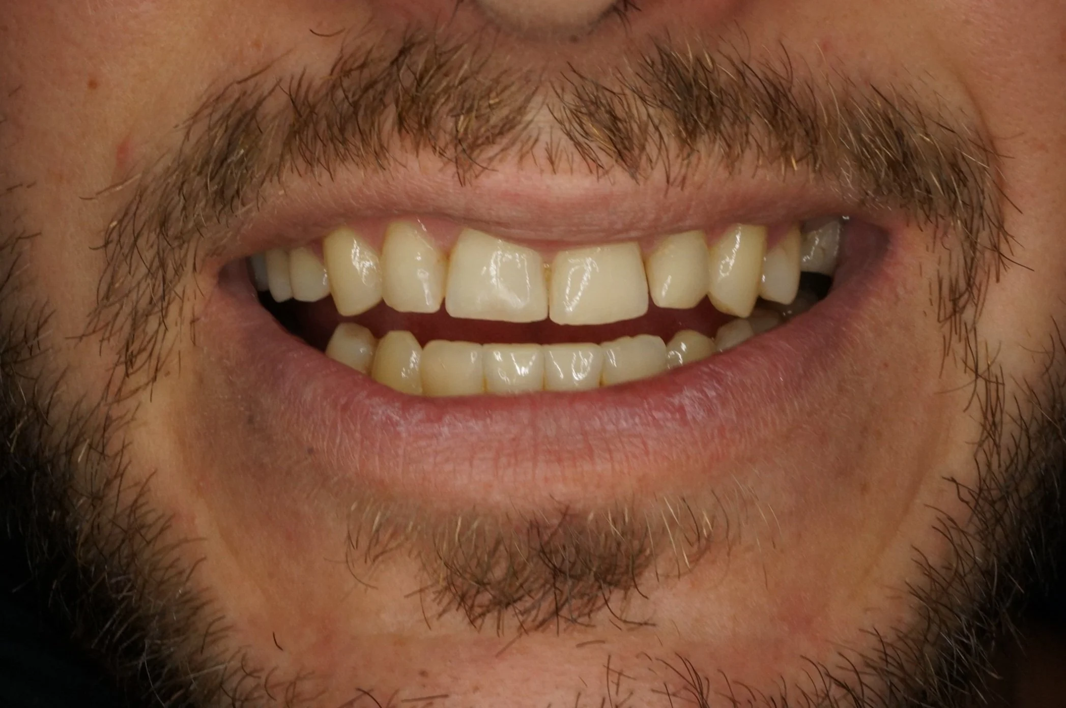 Before - Porcelain veneers