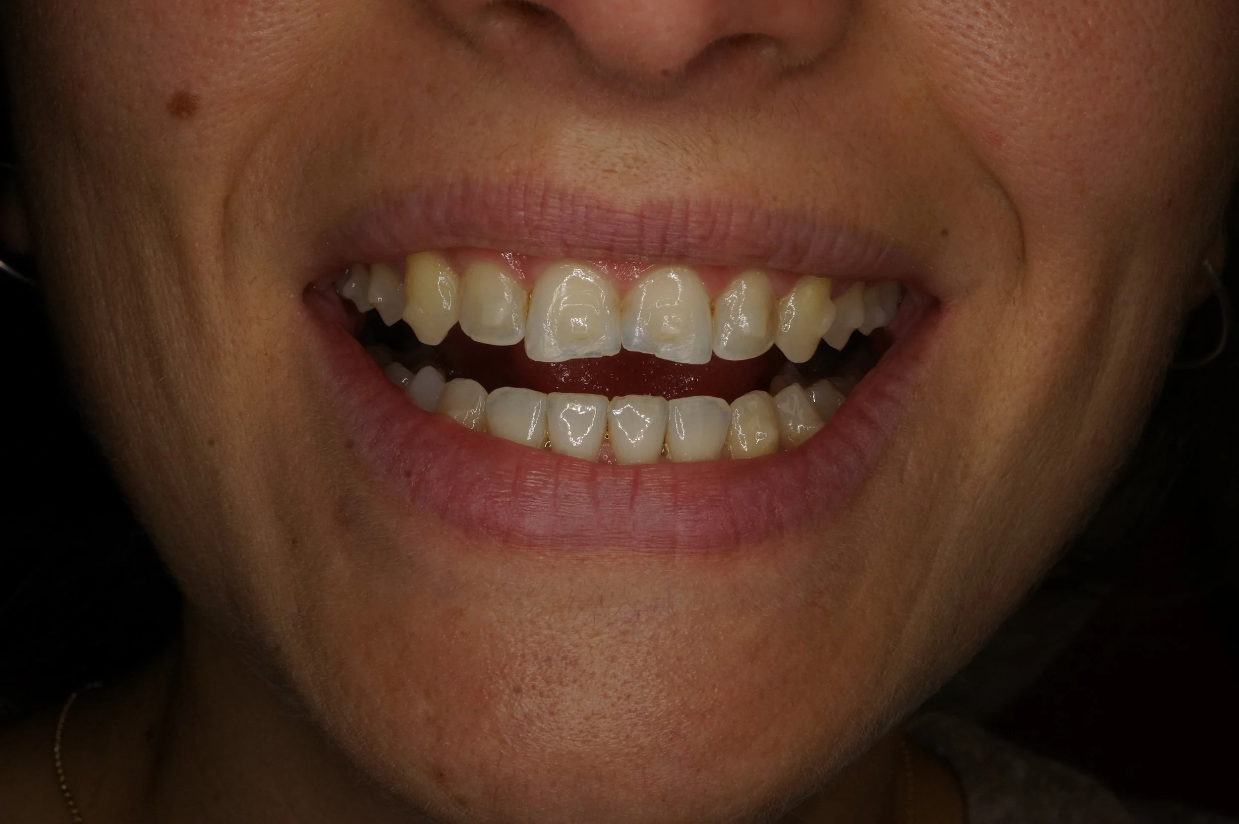 Before - Philips Zoom Whitening & 4 front aesthetic composite restorations