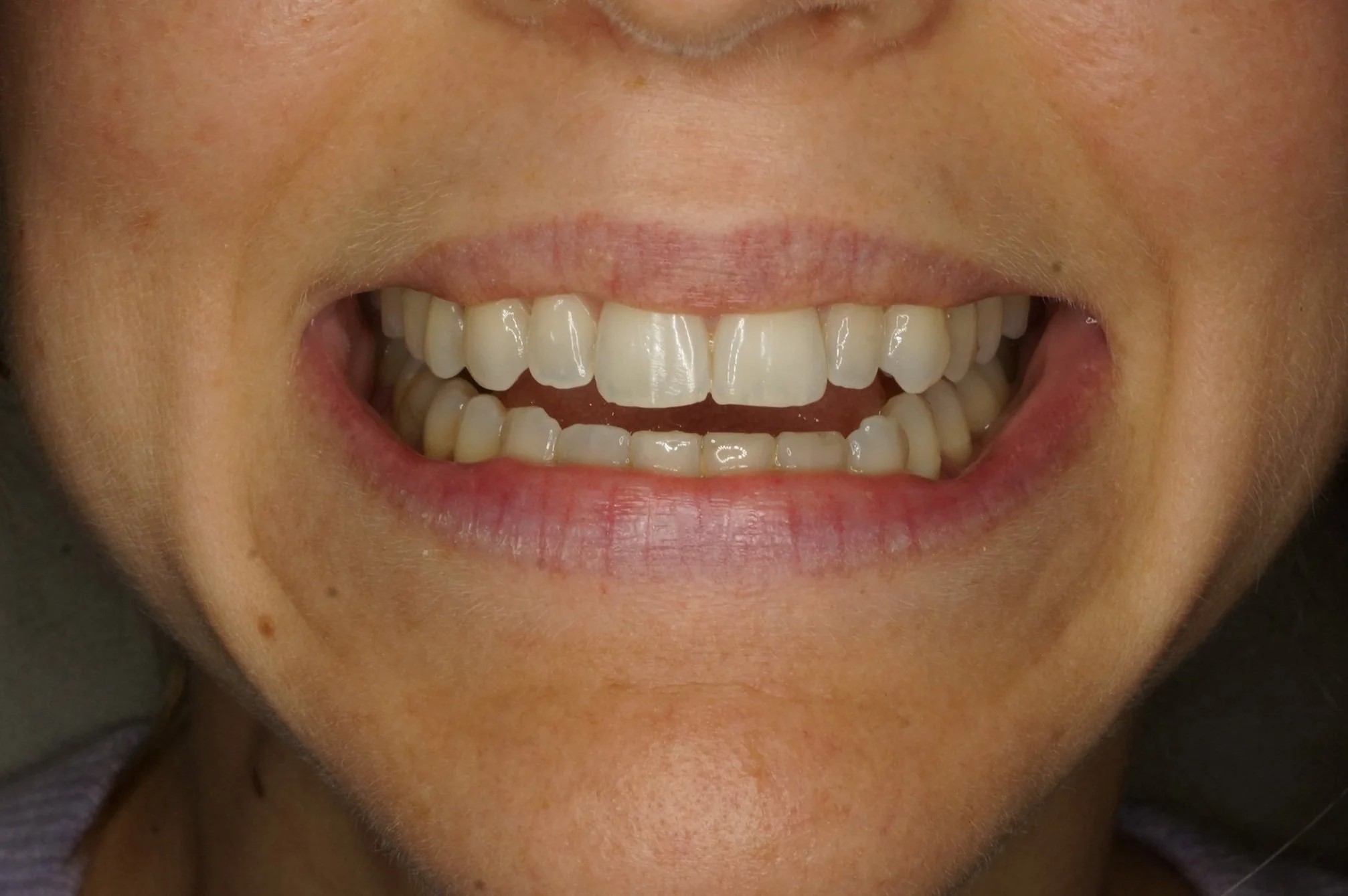 Before - Philips Zoom Whitening & 2 lateral porcelain veneers