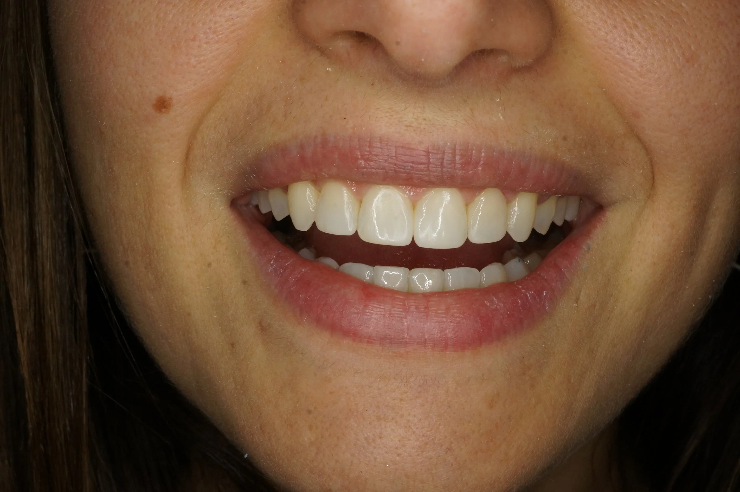 After - Philips Zoom Whitening & 4 front aesthetic composite restorations