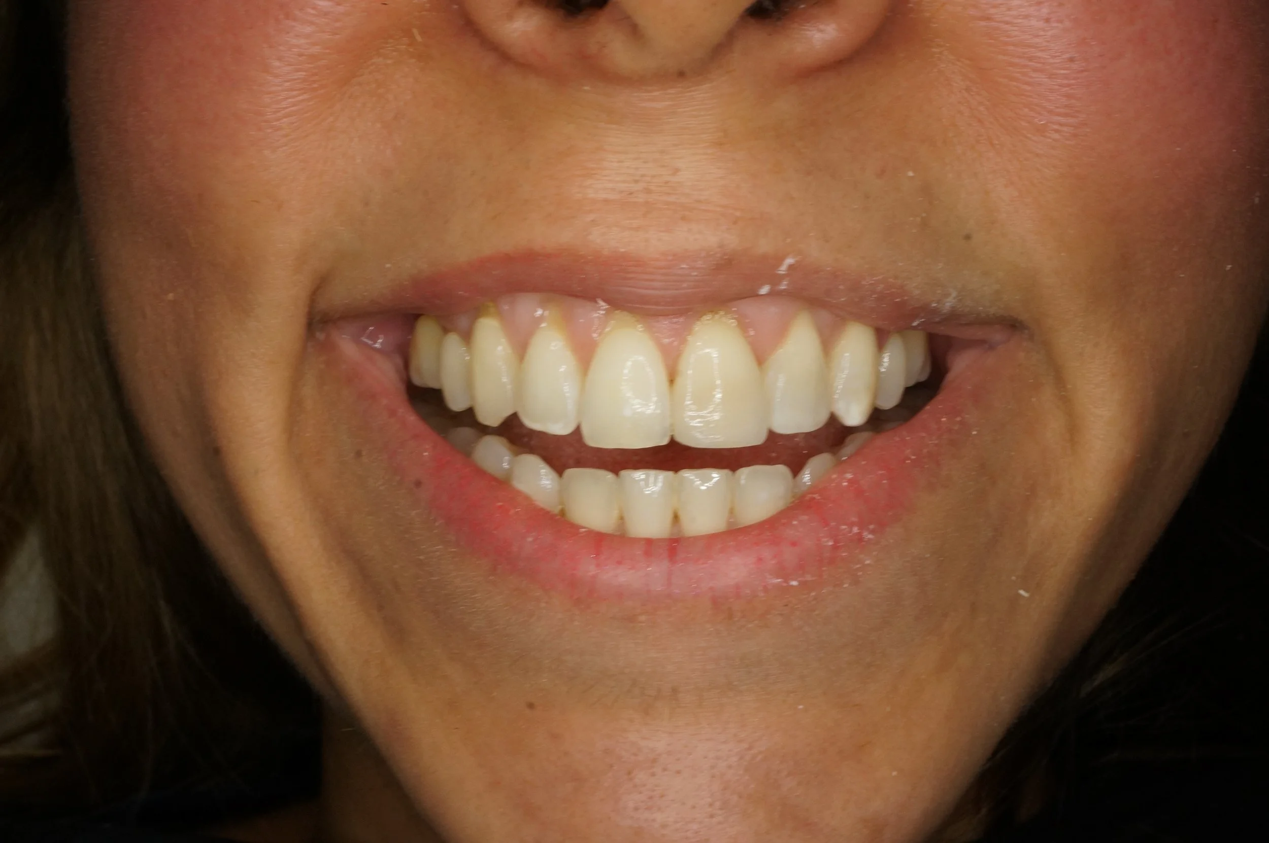 After - Philips Zoom Whitening, front tooth internal whitening, 1 composite veneer & 1 lateral incisor composite restoration
