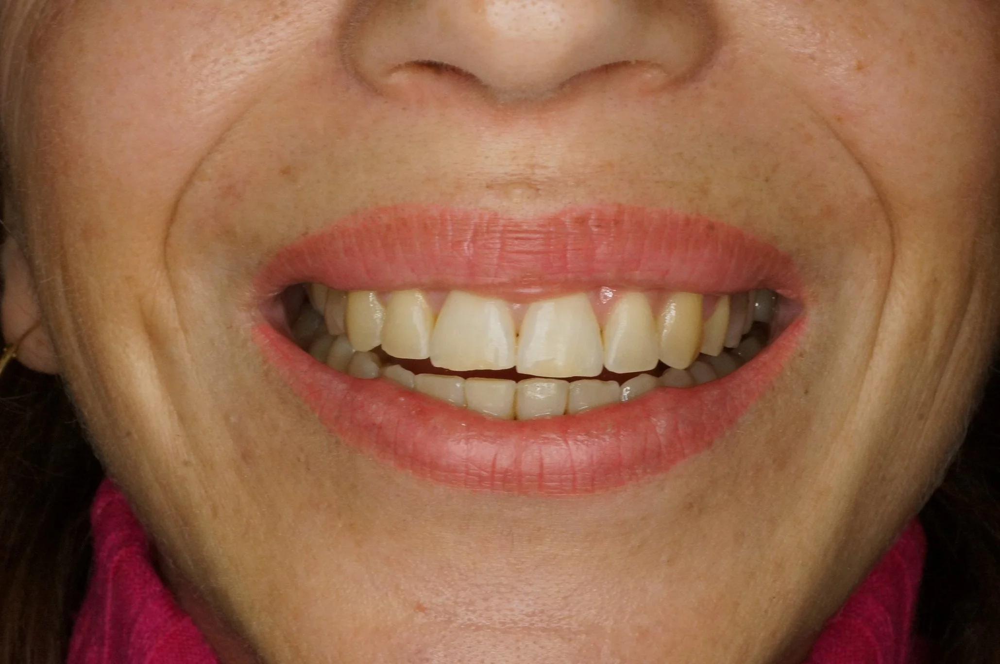 Before - Philips Zoom whitening & 4 front incisors composite restorations & posterior porcelain veneer to amplify the smile