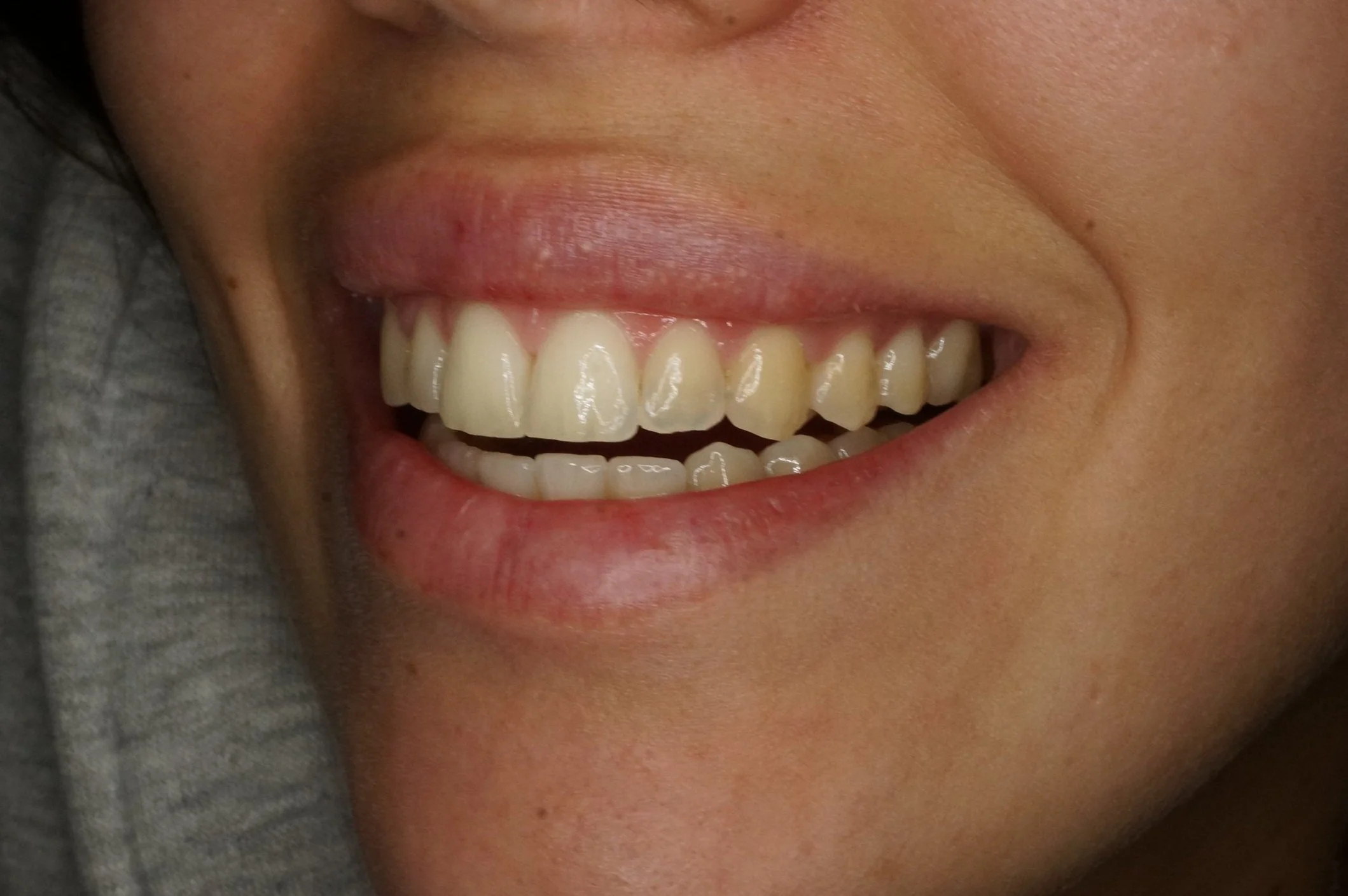 Before - Whitening & composite reconstructions