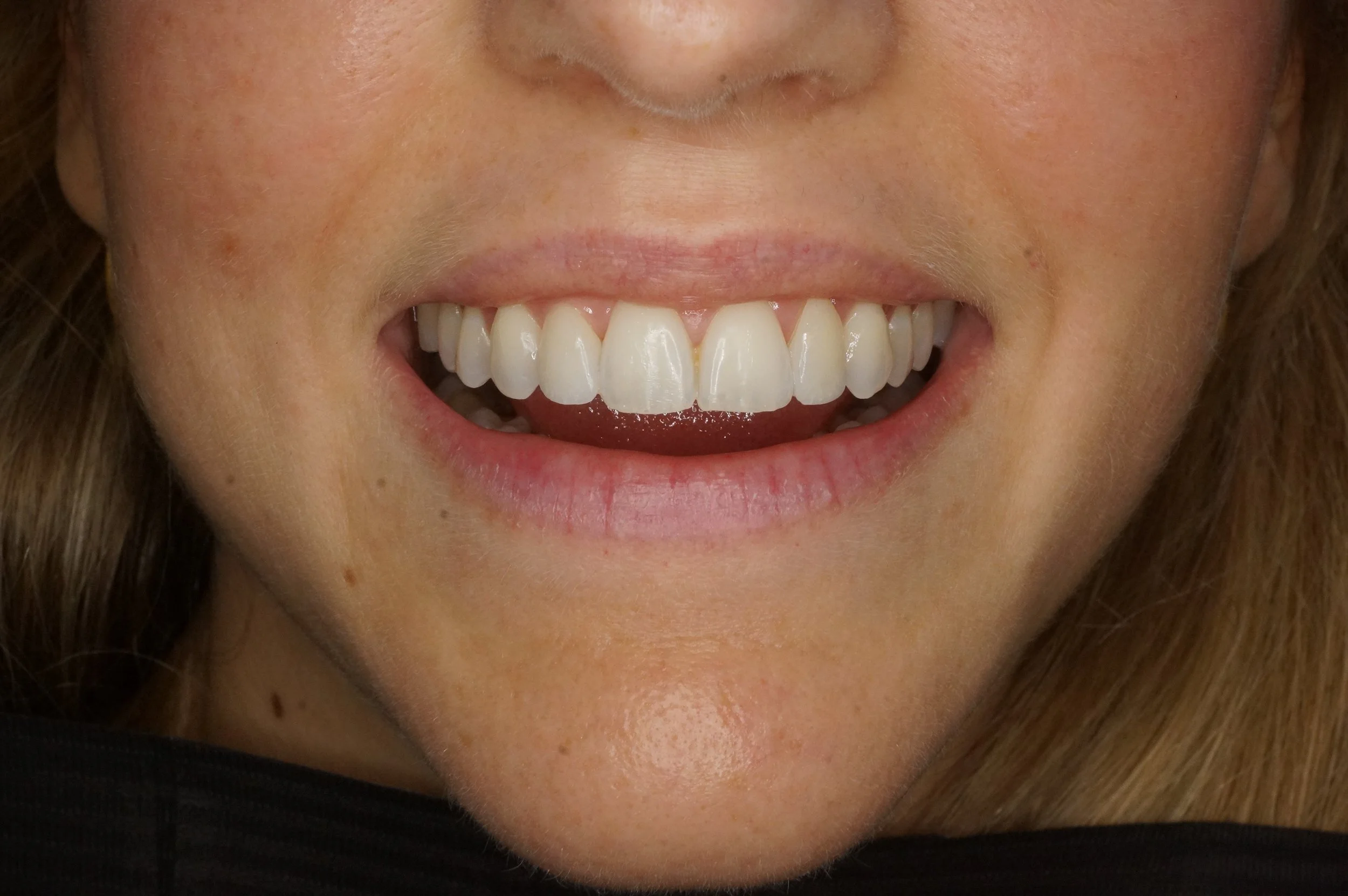 After - Philips Zoom Whitening & 2 lateral porcelain veneers