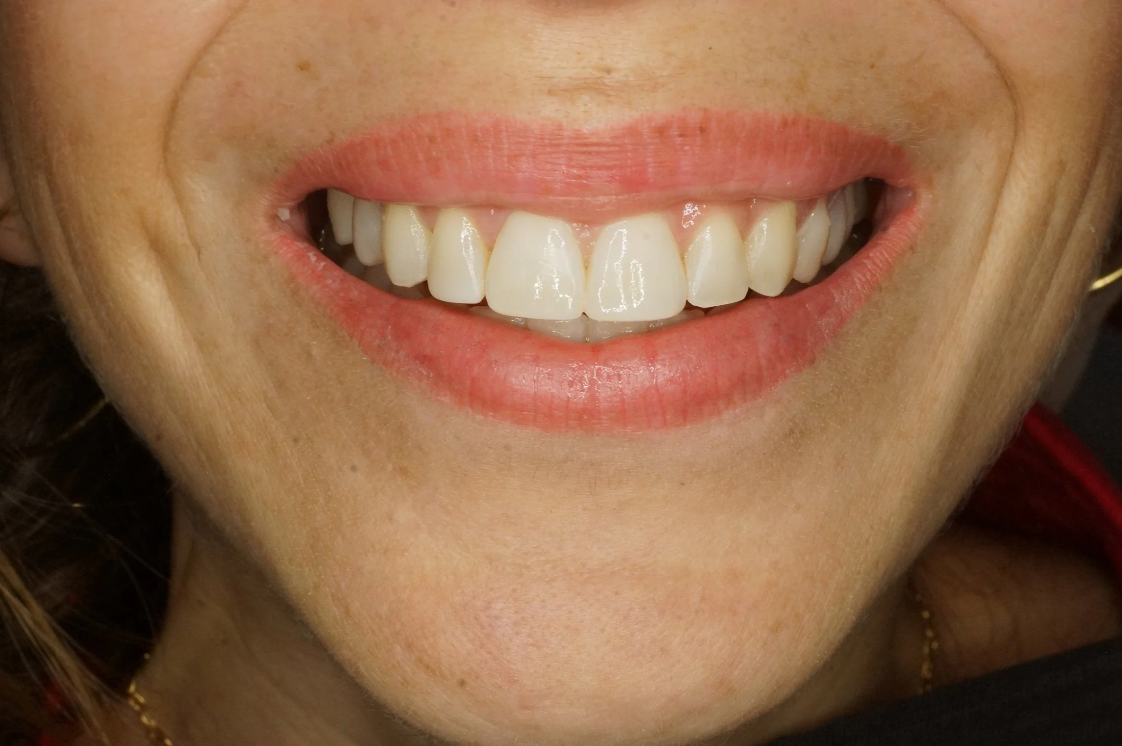 After - Philips Zoom whitening & 4 front incisors composite restorations & posterior porcelain veneer to amplify the smile