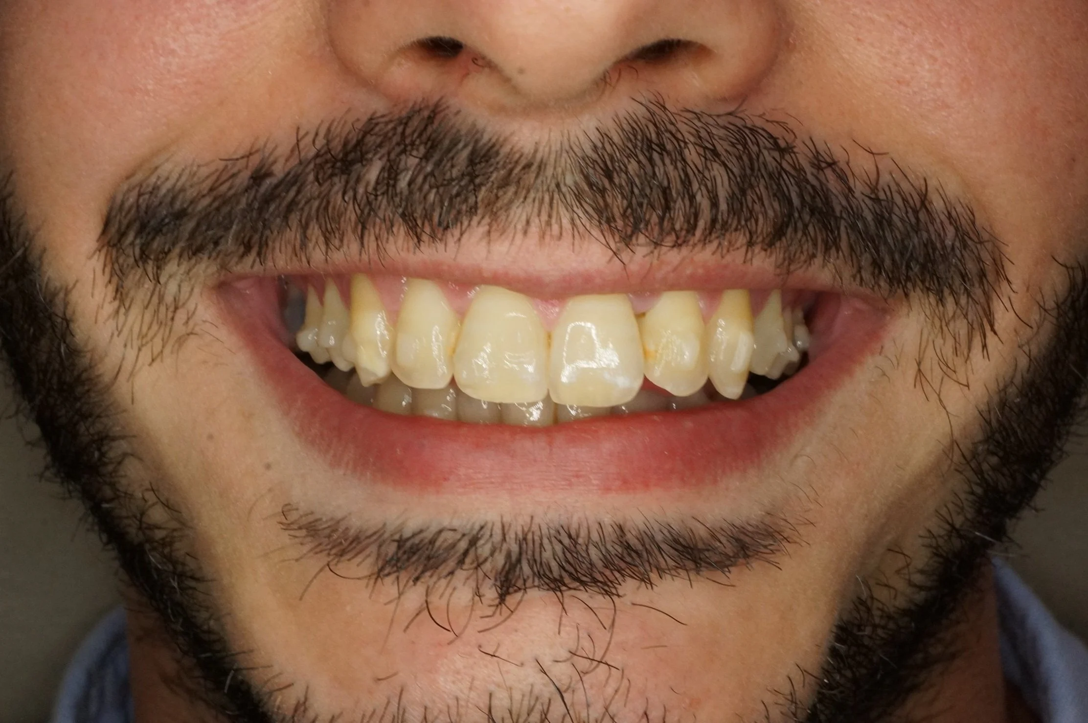 Before - Philips Zoom whitening