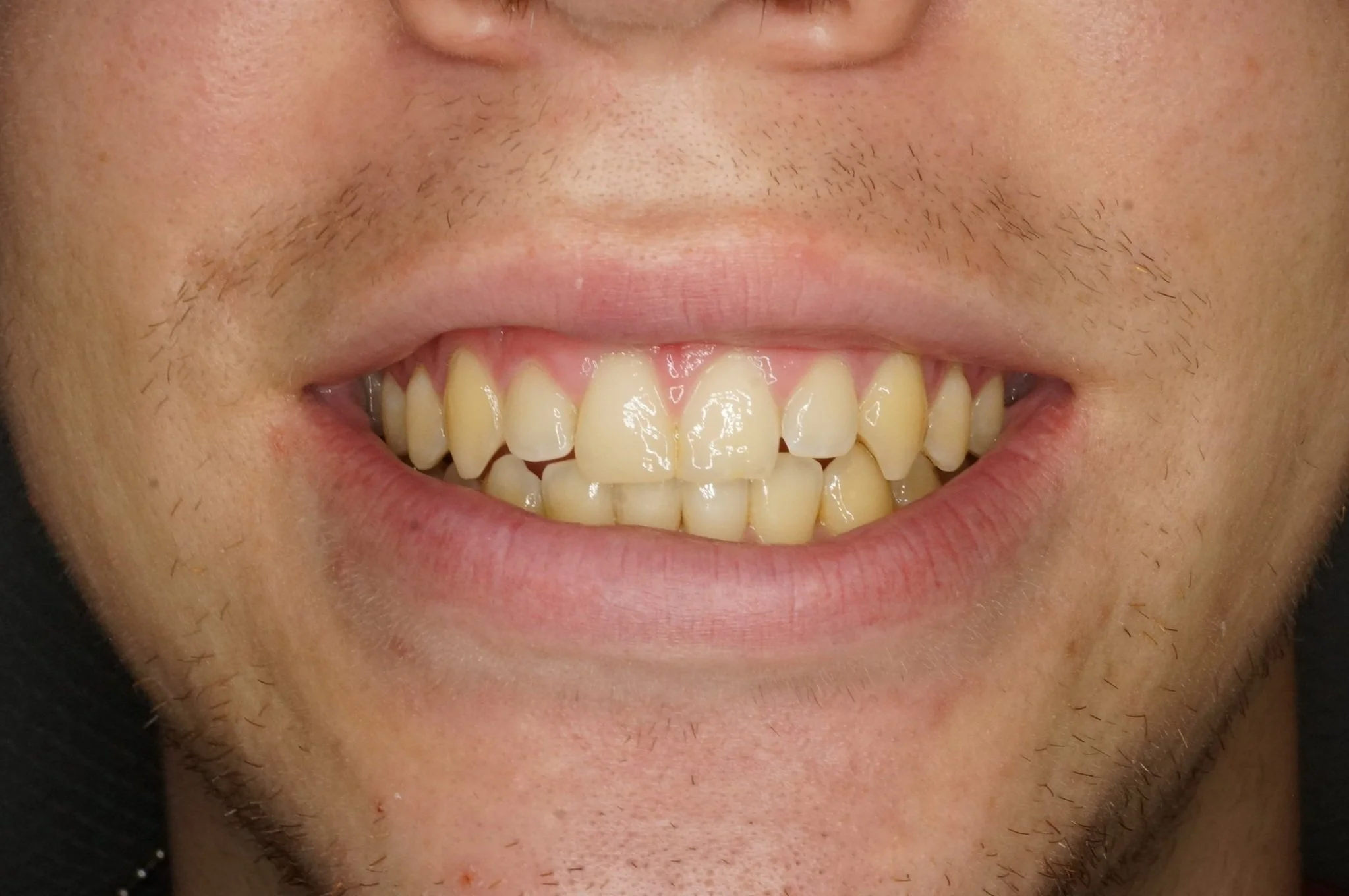 Before - Philips Zoom whitening & 2 lateral composite restorations