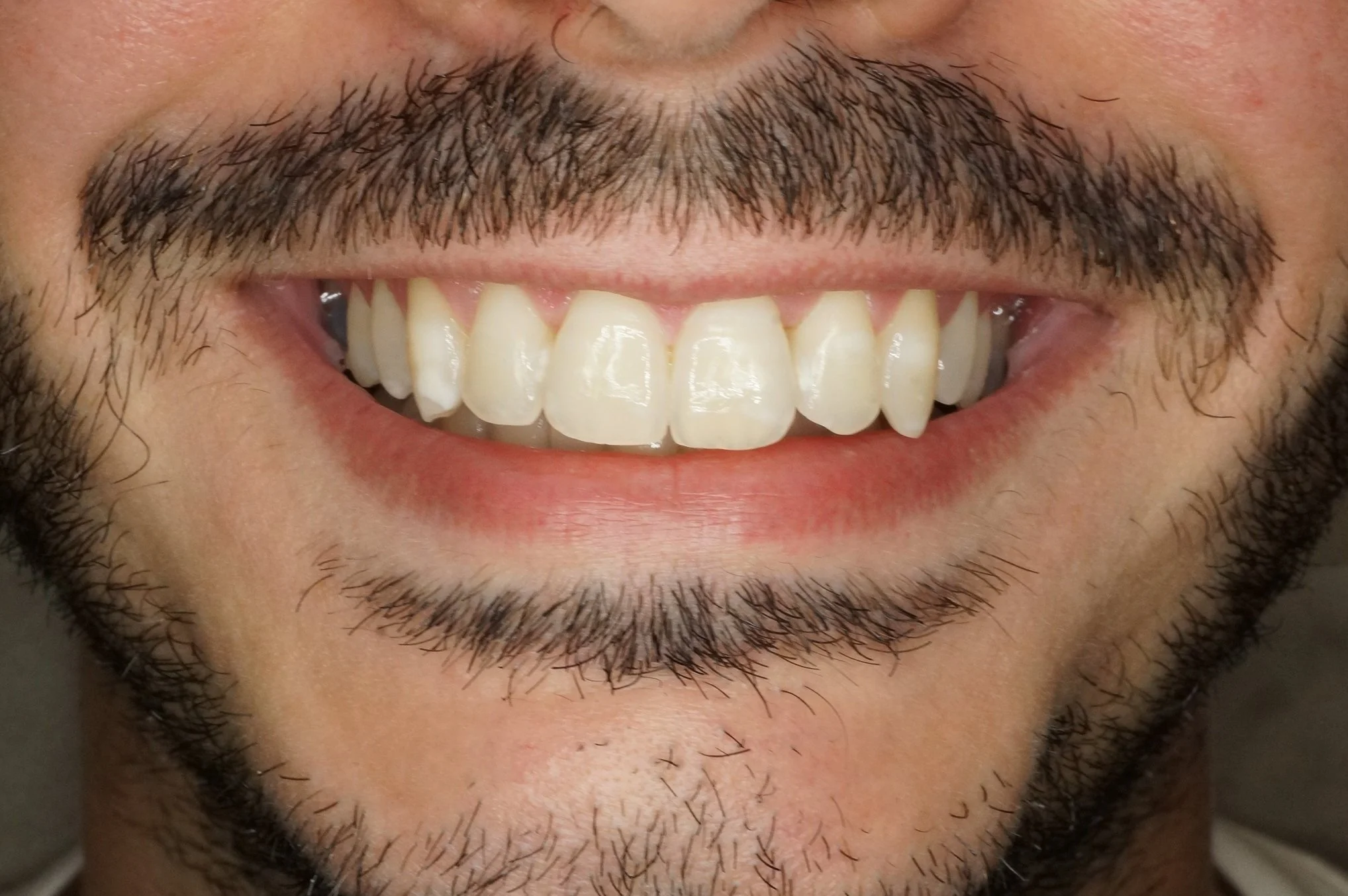 After - Philips Zoom whitening