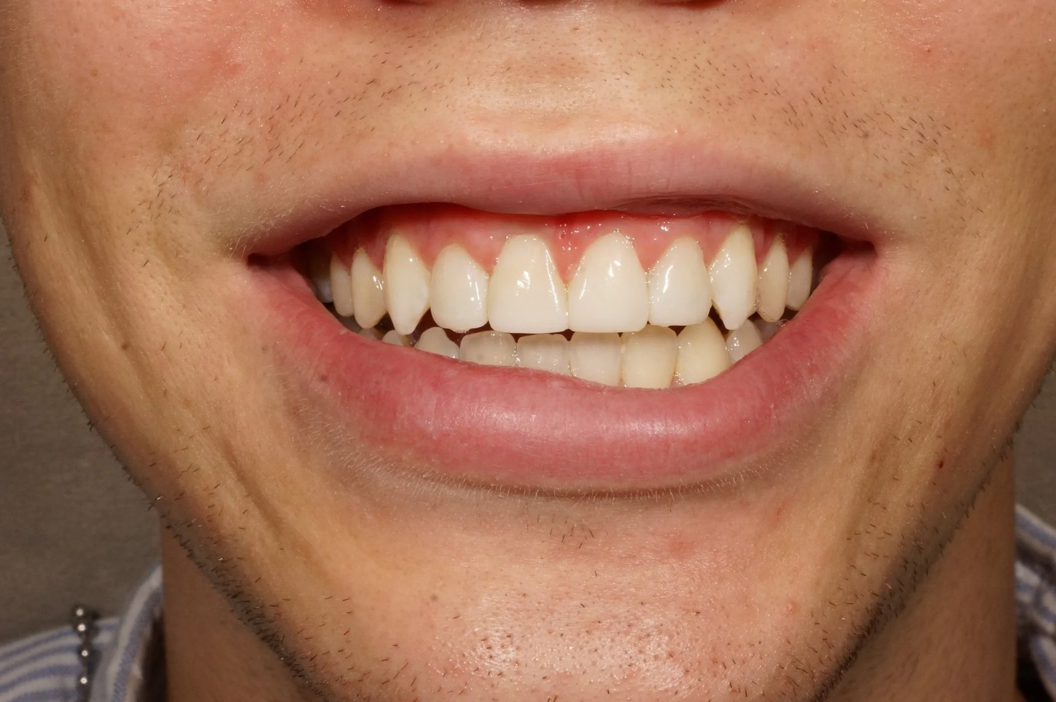 After - Philips Zoom whitening & 2 lateral composite restorations