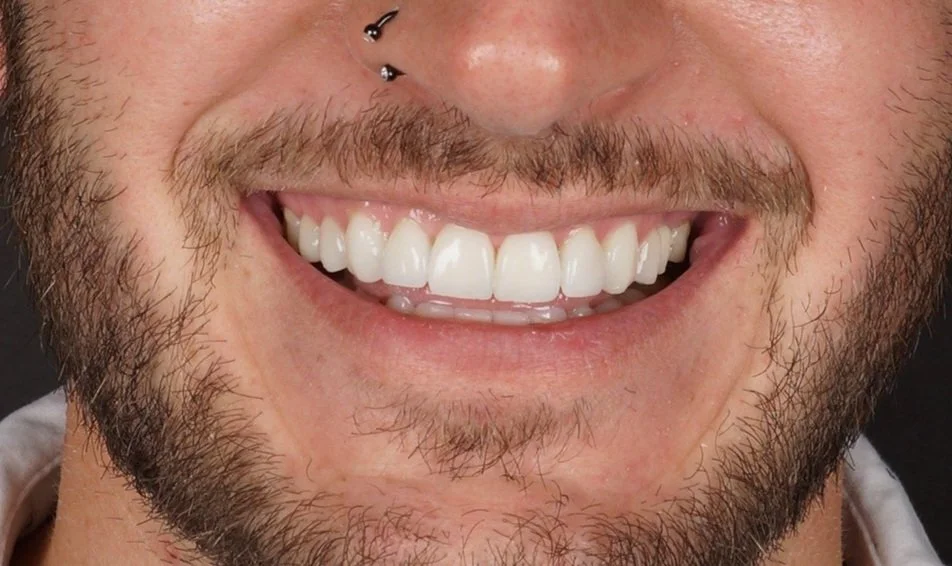 After - Porcelain veneers