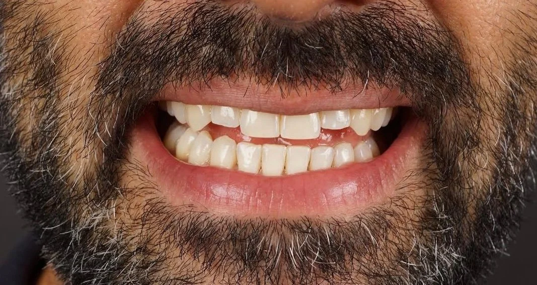 Before - Philips Zoom whitening & 2 lateral incisors composite restorations