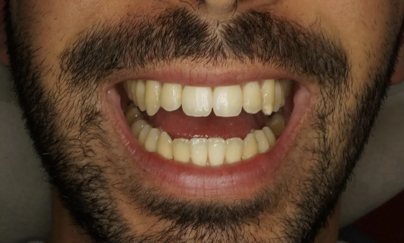 Before - Philips Zoom whitening & 4 incisors composite restorations