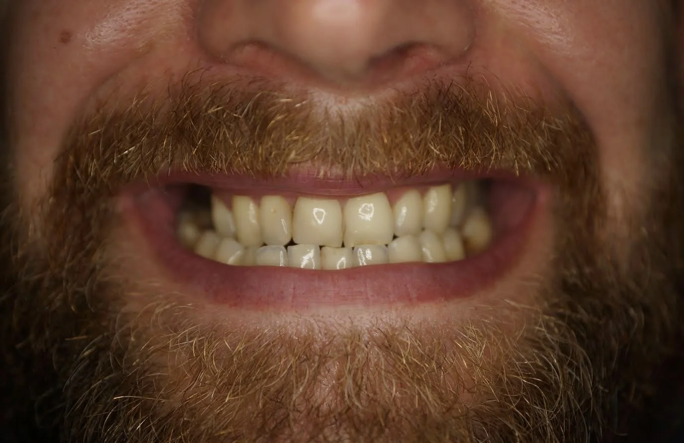 Before - Invisalign and full mouth rehabilitation with porcelain veneers, crowns and onlays
