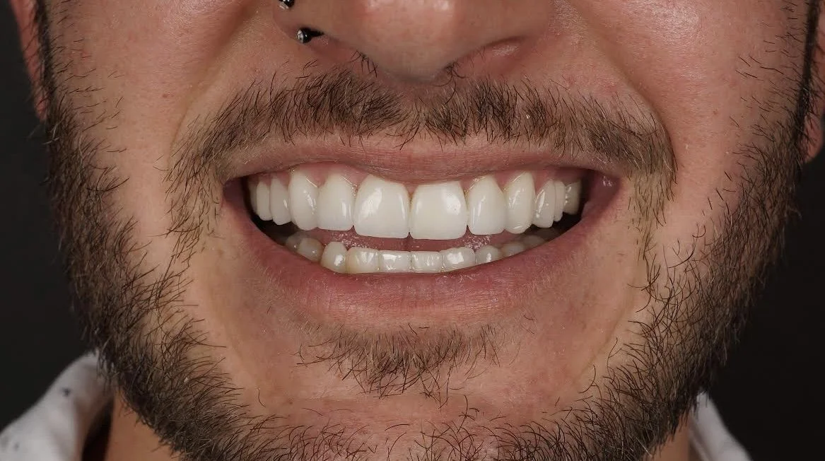 After - Invisalign and 10 upper arch porcelain veneers