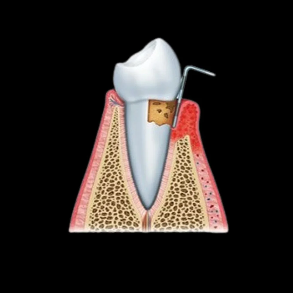 Periodontitis