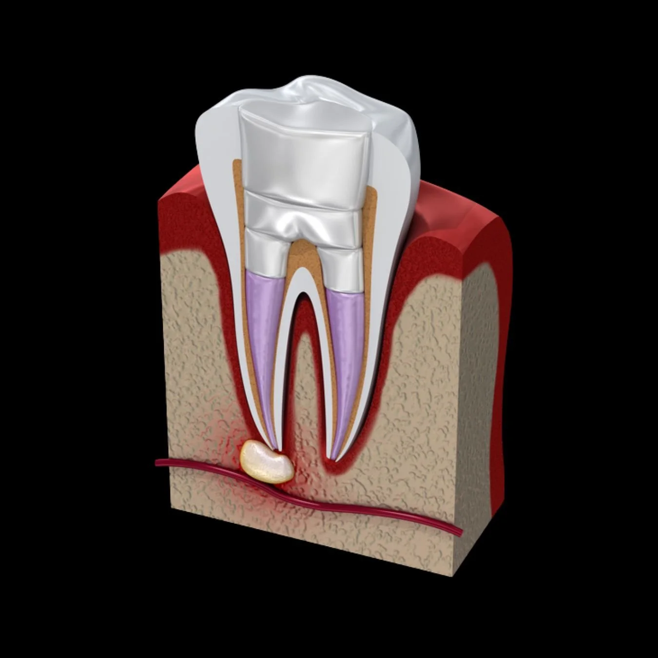Root Canal Retreatment