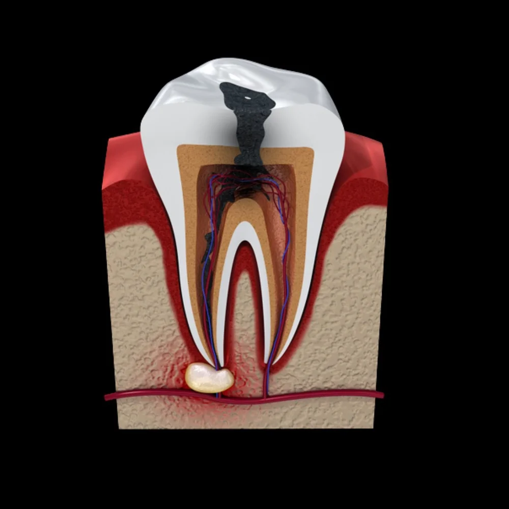 Root Canal Treatment