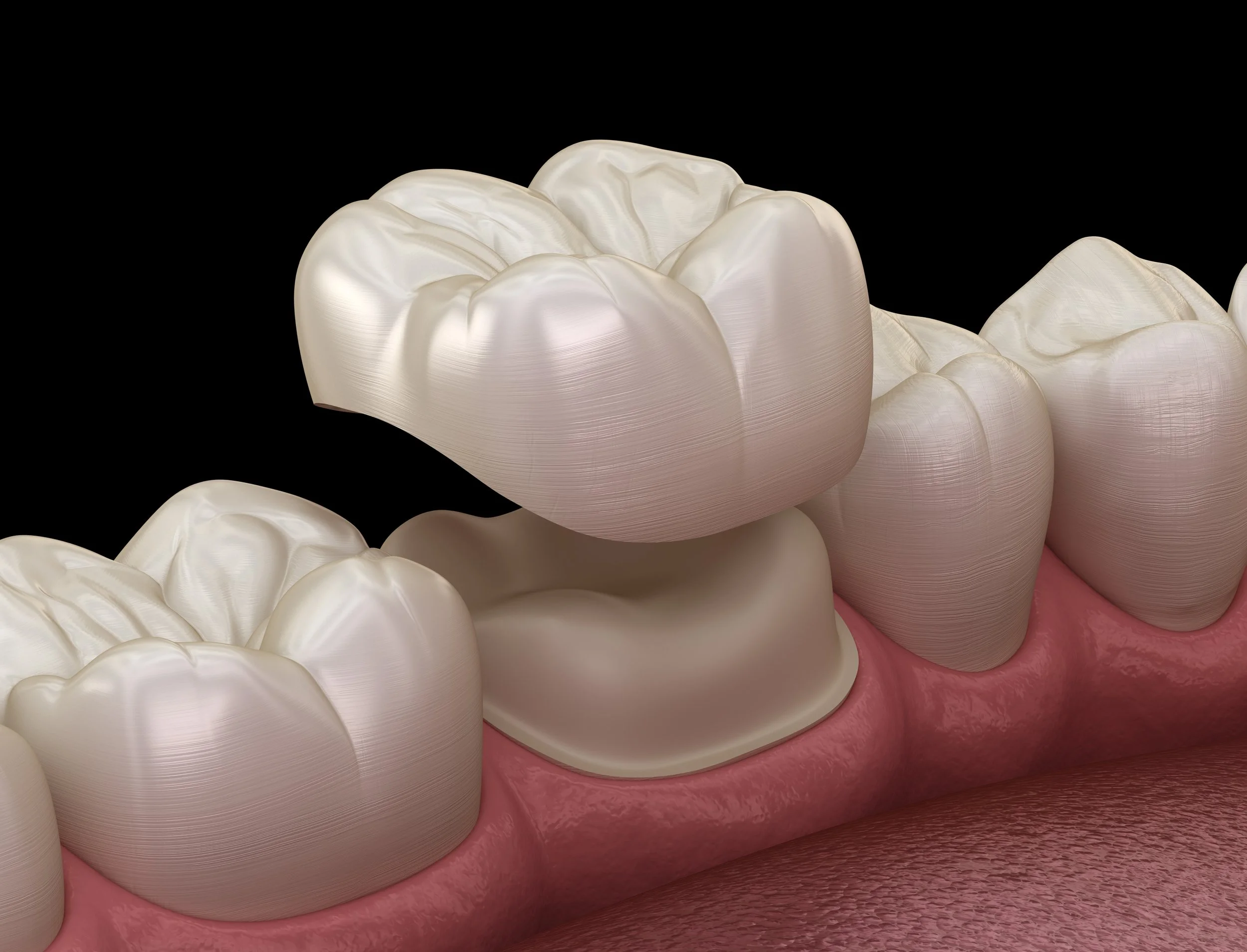 Metal-free Crowns and Bridges