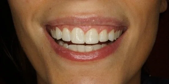 After - Philips Zoom Whitening and Gingivoplasty front aesthetic composite restorations 