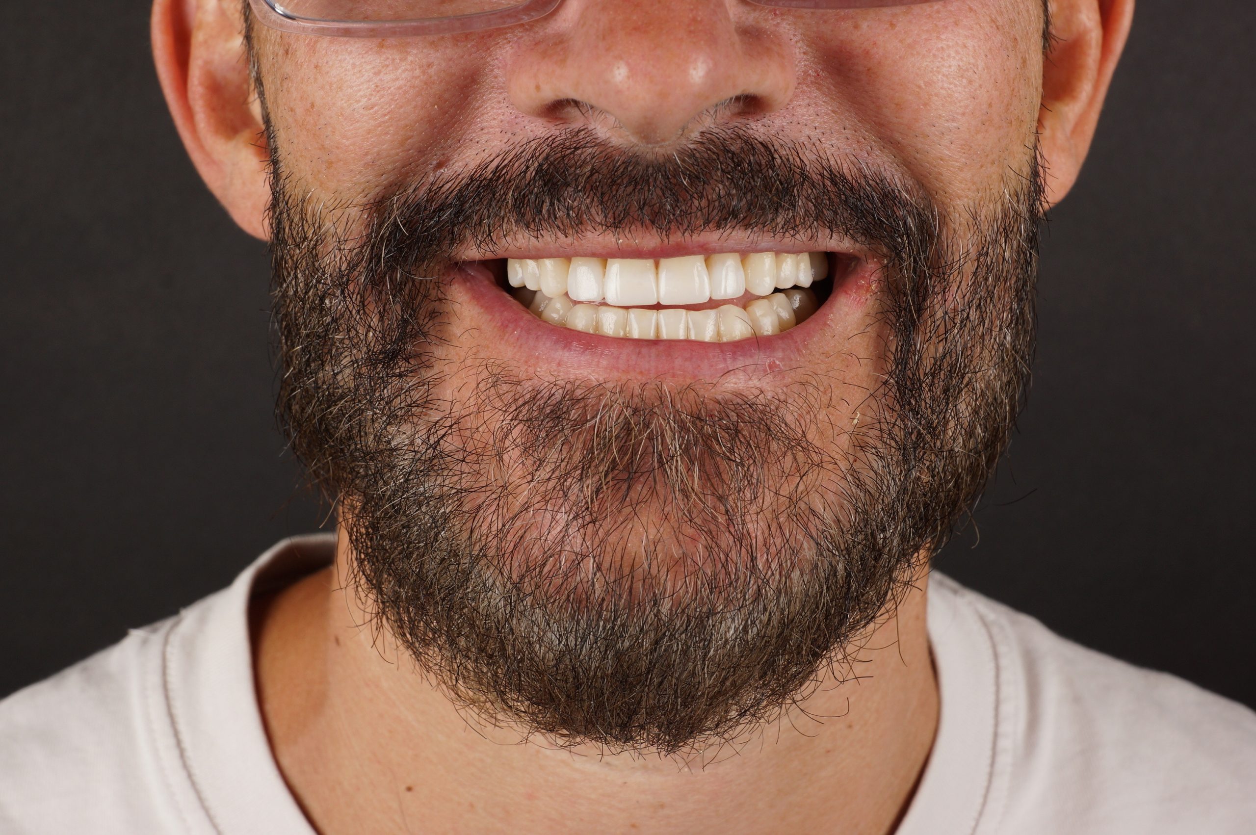 After - Philips Zoom whitening + 4 aesthetic composite reconstructions