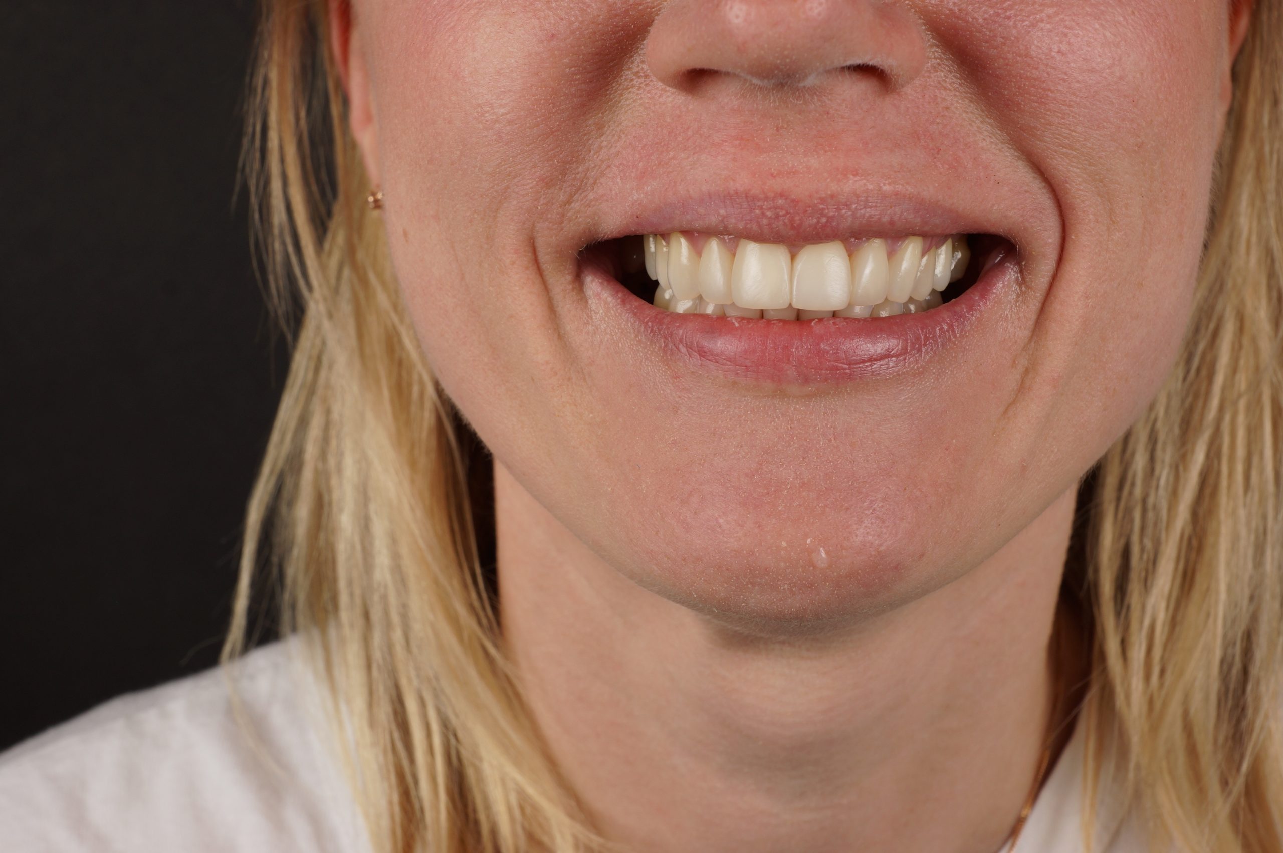 After - Philips Zoom whitening + 2 aesthetic composite reconstructions