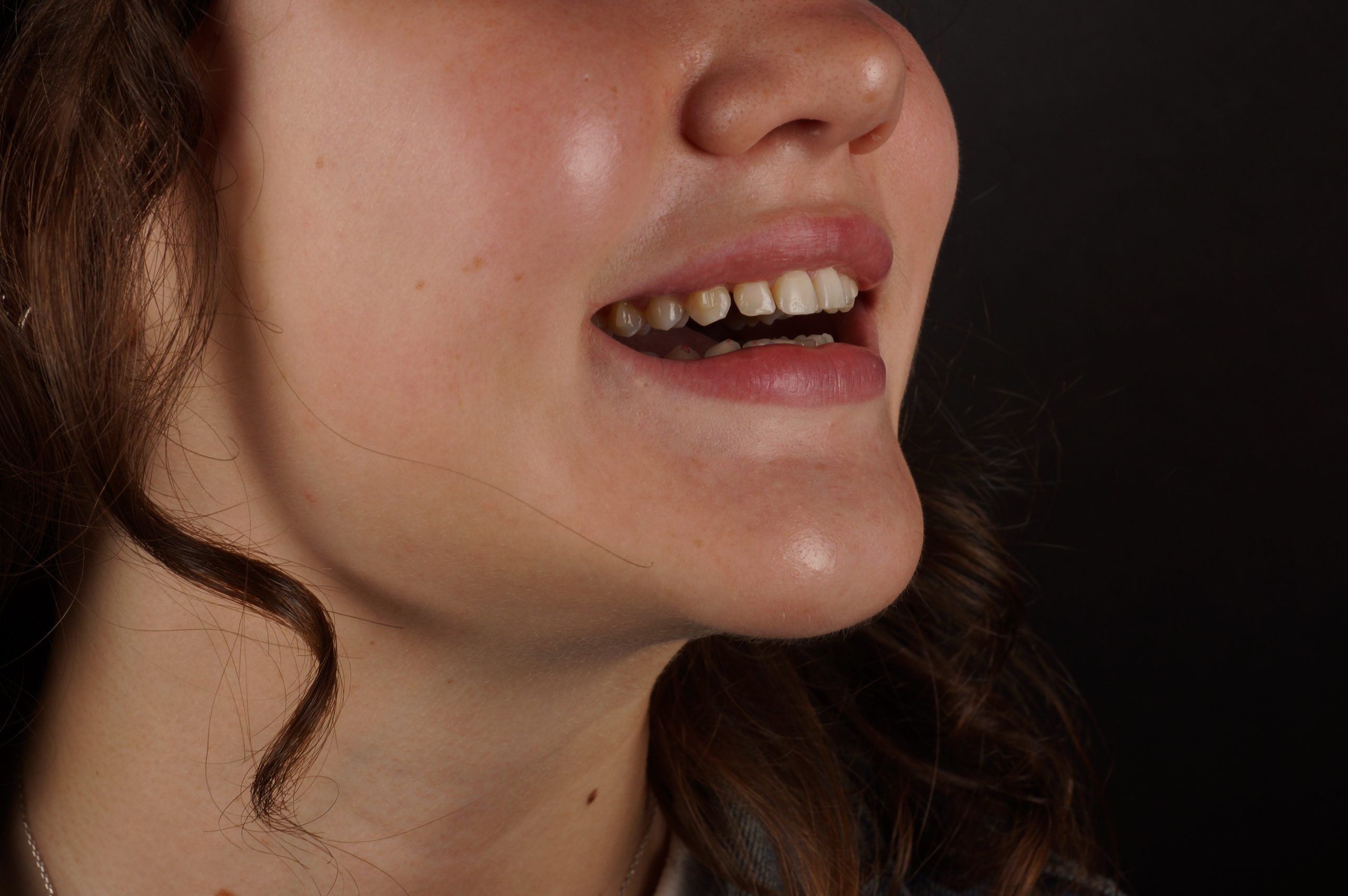 Before - Philips Zoom whitening + 8 aesthetic composite veneers