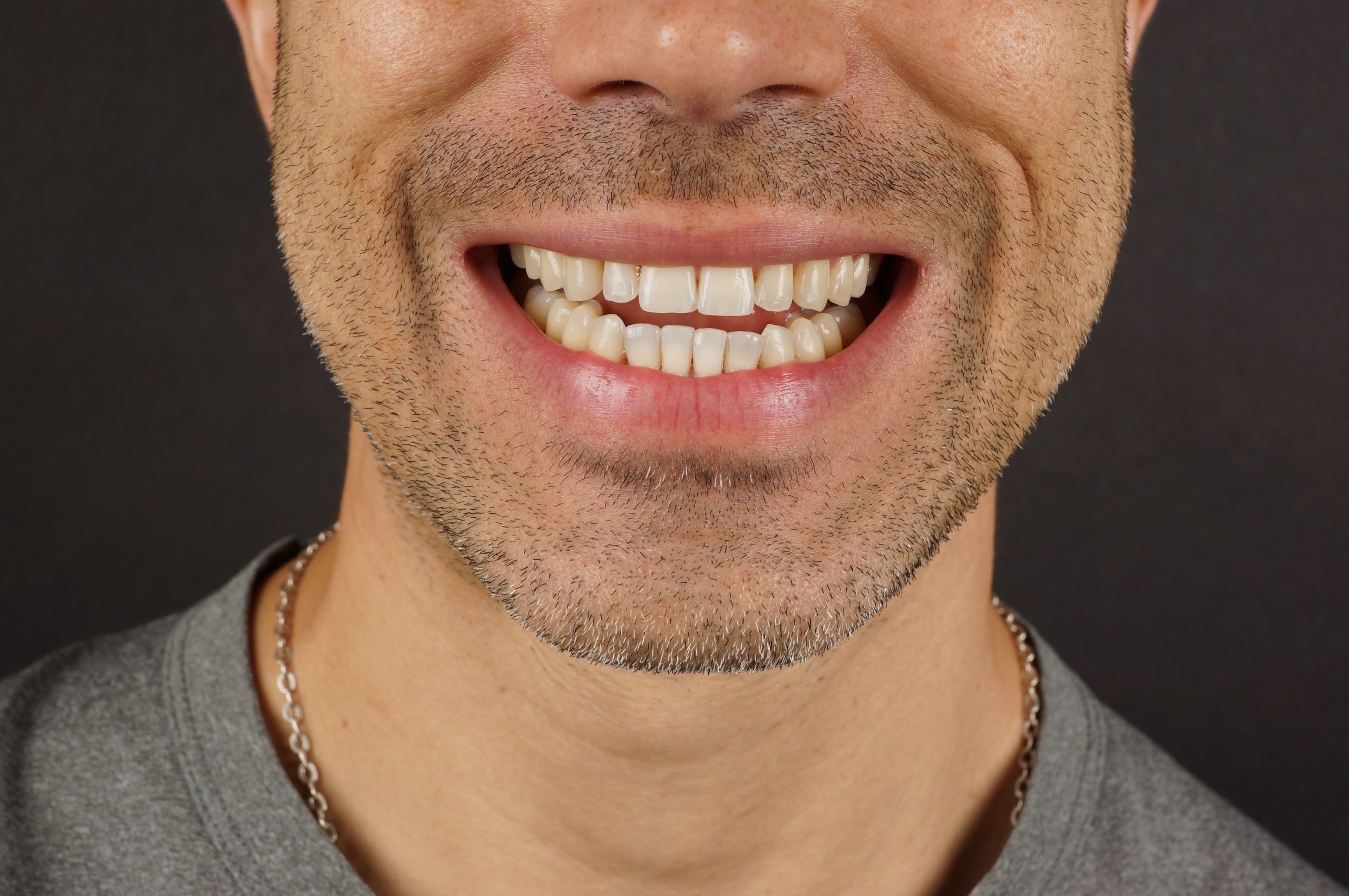 After - 8 cervical reconstructions + Philips Zoom whitening + 2 aesthetic composite reconstructions