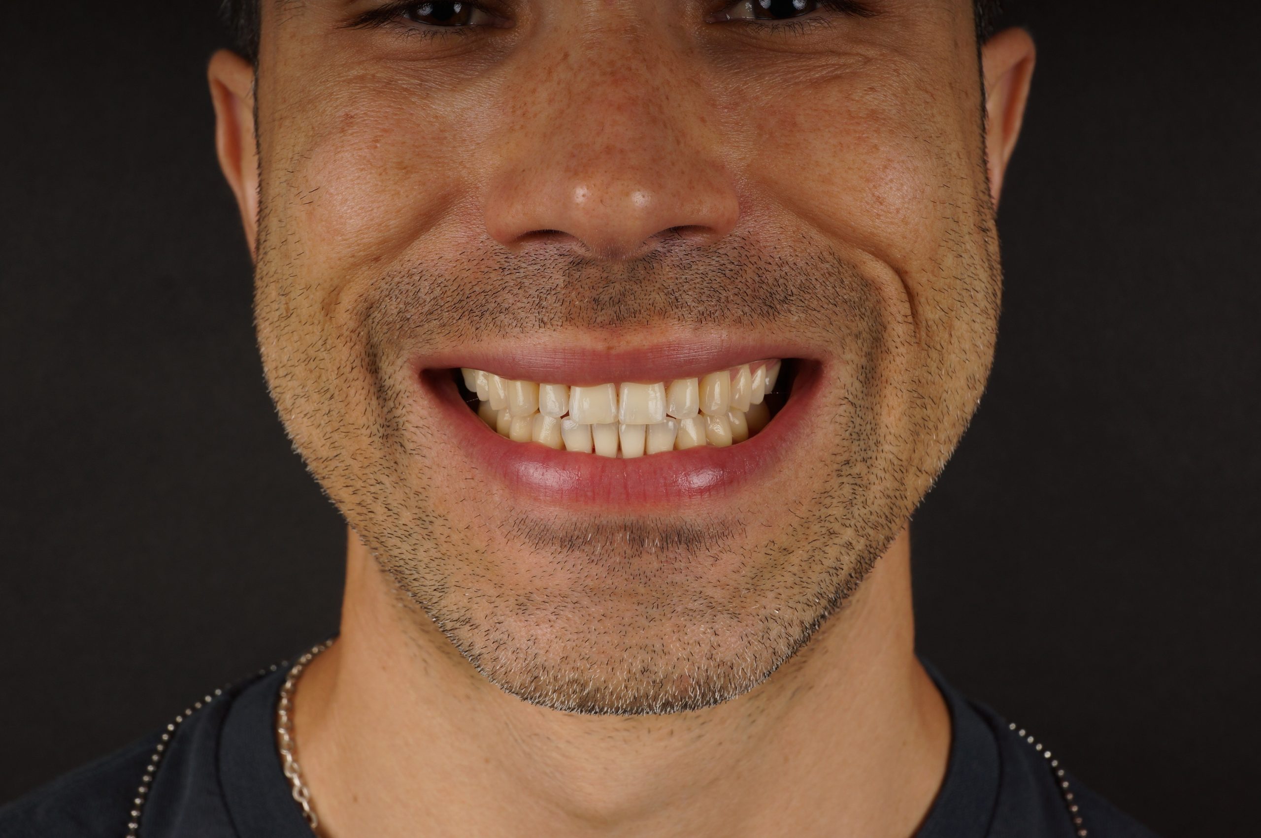 Before - 8 cervical reconstructions + Philips Zoom whitening + 2 aesthetic composite reconstructions