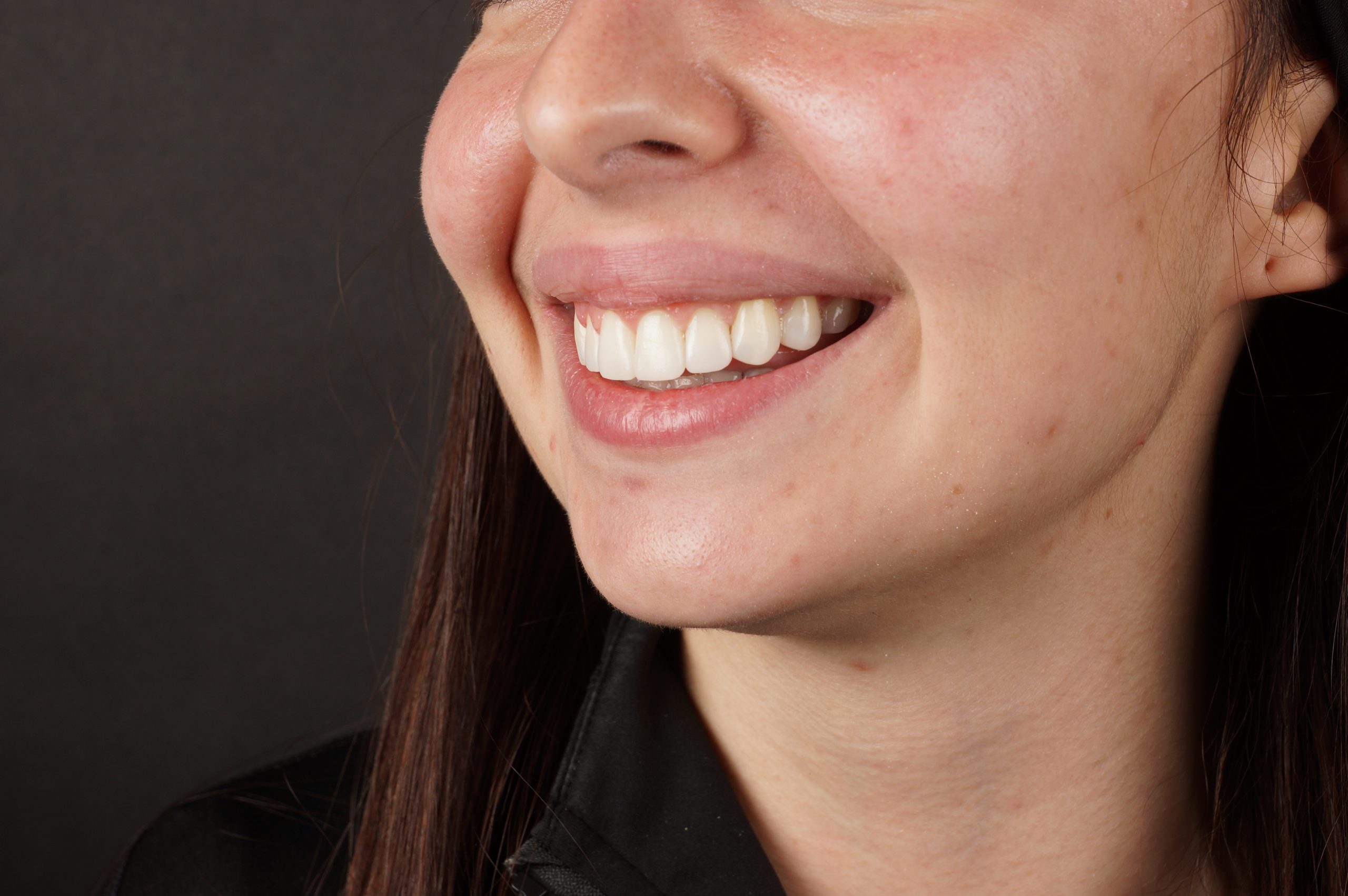 After - Crown lengthening + Philips Zoom whitening + 8 aesthetic composite reconstructions