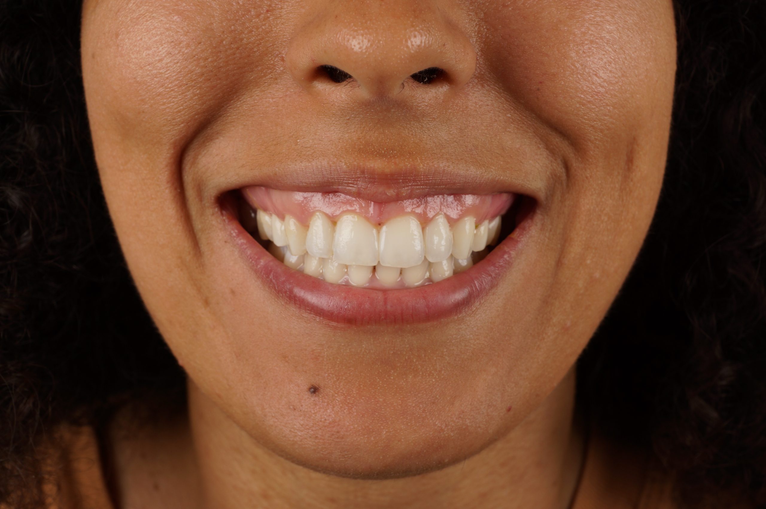 After - 4 aesthetic composite reconstructions