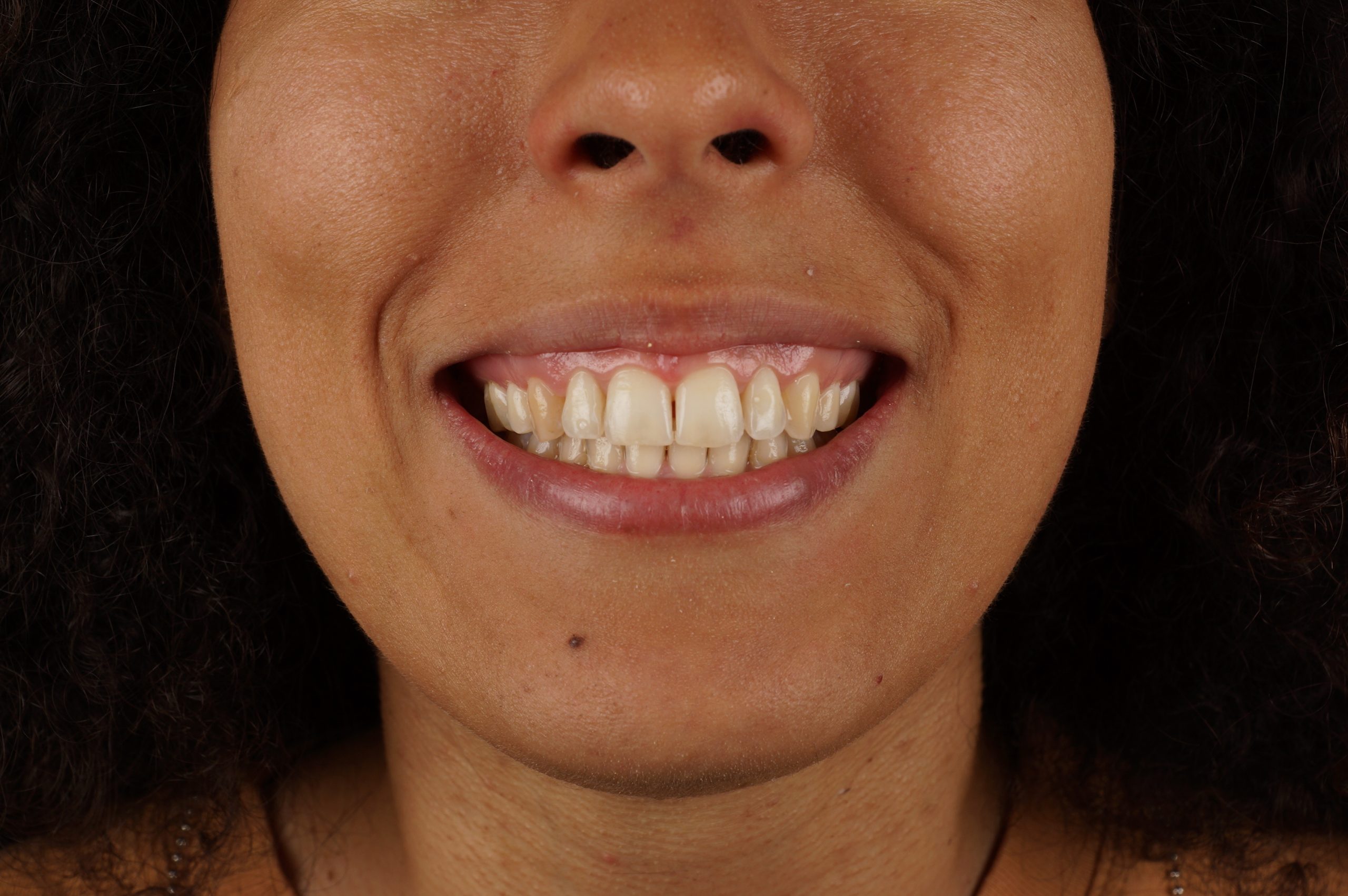 Before - 4 aesthetic composite reconstructions