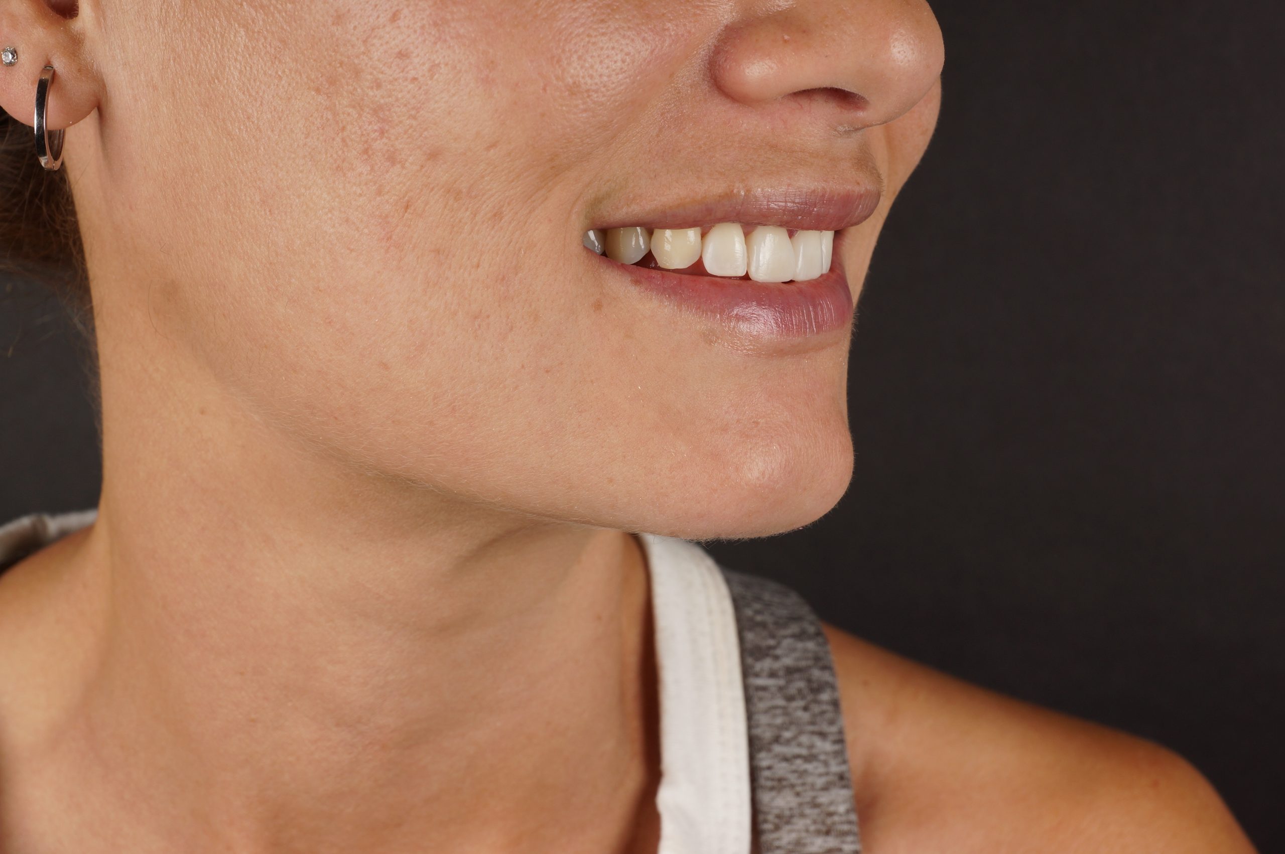 After - 4 aesthetic composite reconstructions