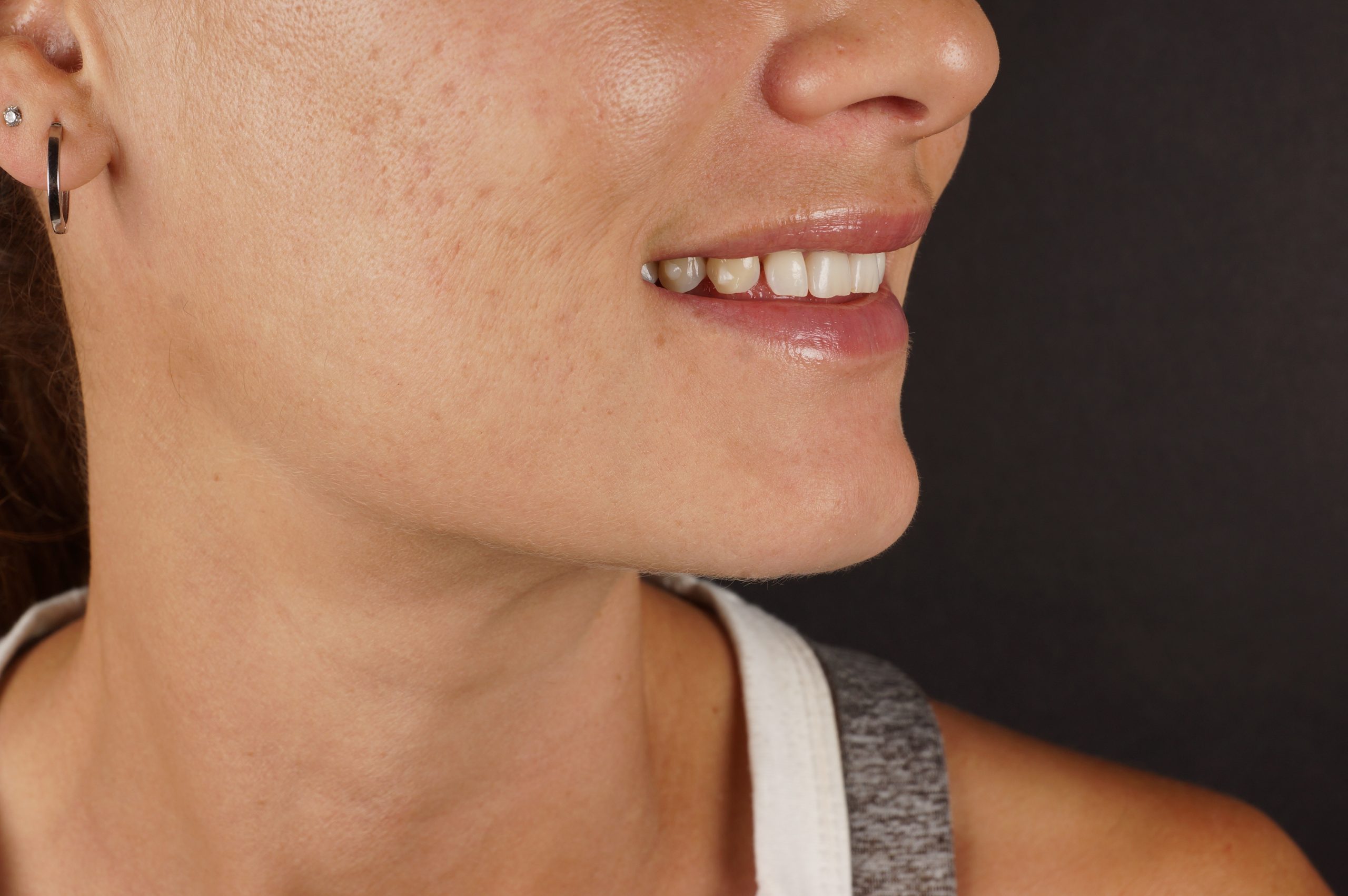 Before - 4 aesthetic composite reconstructions