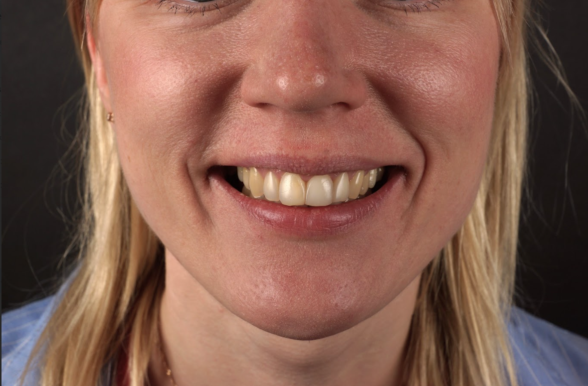Before - Philips Zoom whitening + 2 aesthetic composite reconstructions