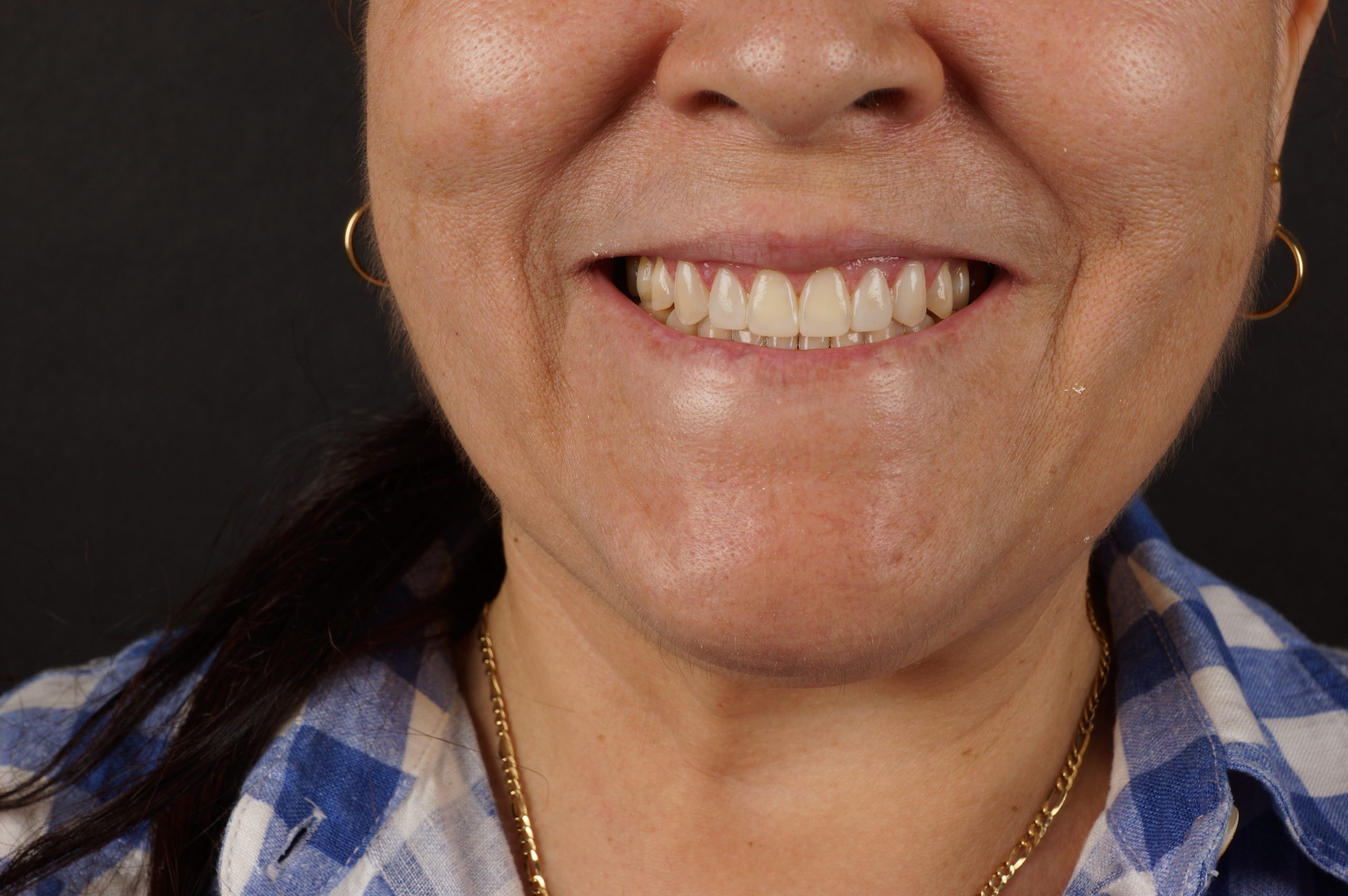 After - Philips Zoom whitening + 6 aesthetic composite reconstructions