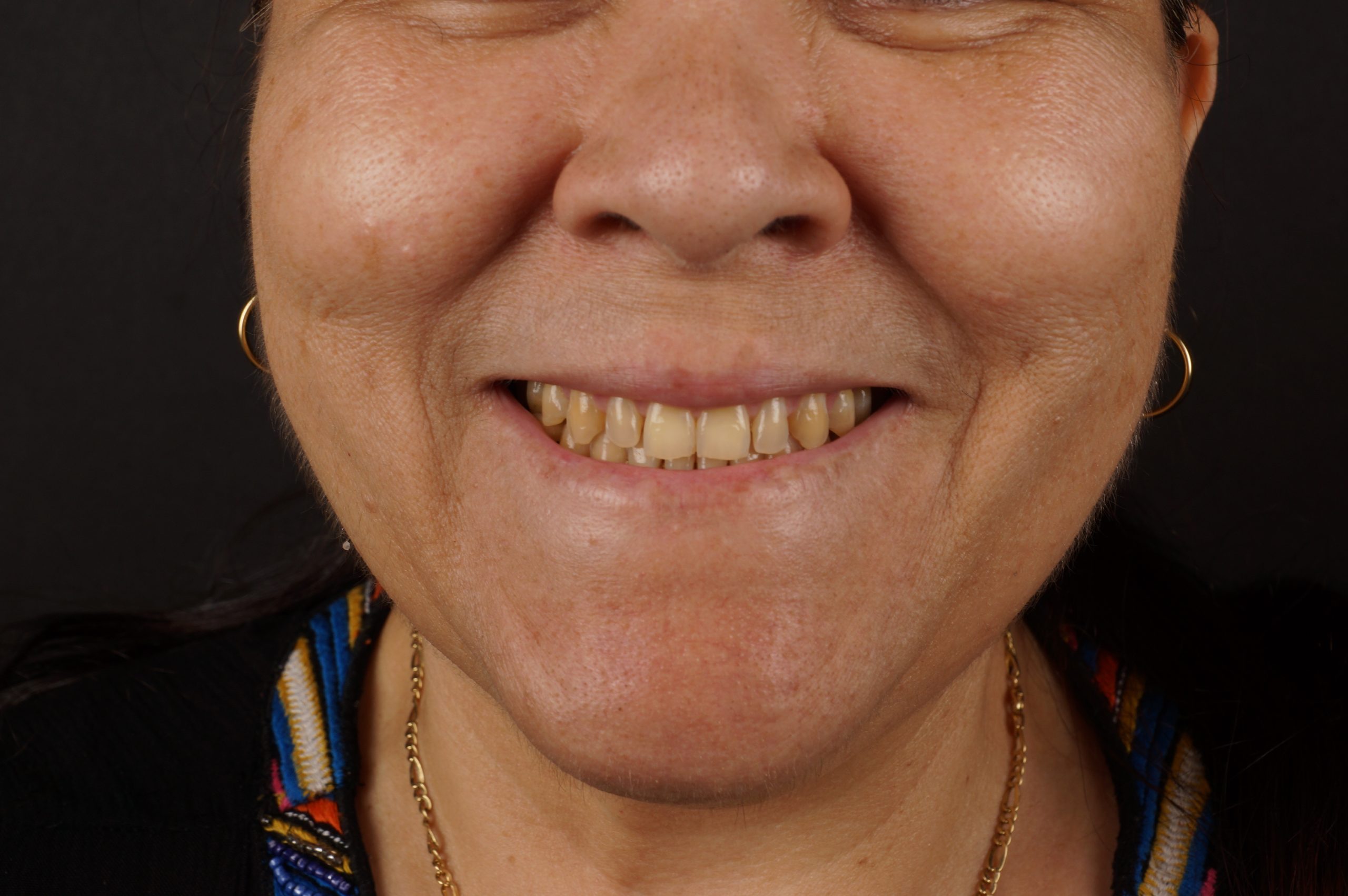 Before - Philips Zoom whitening + 6 aesthetic composite reconstructions