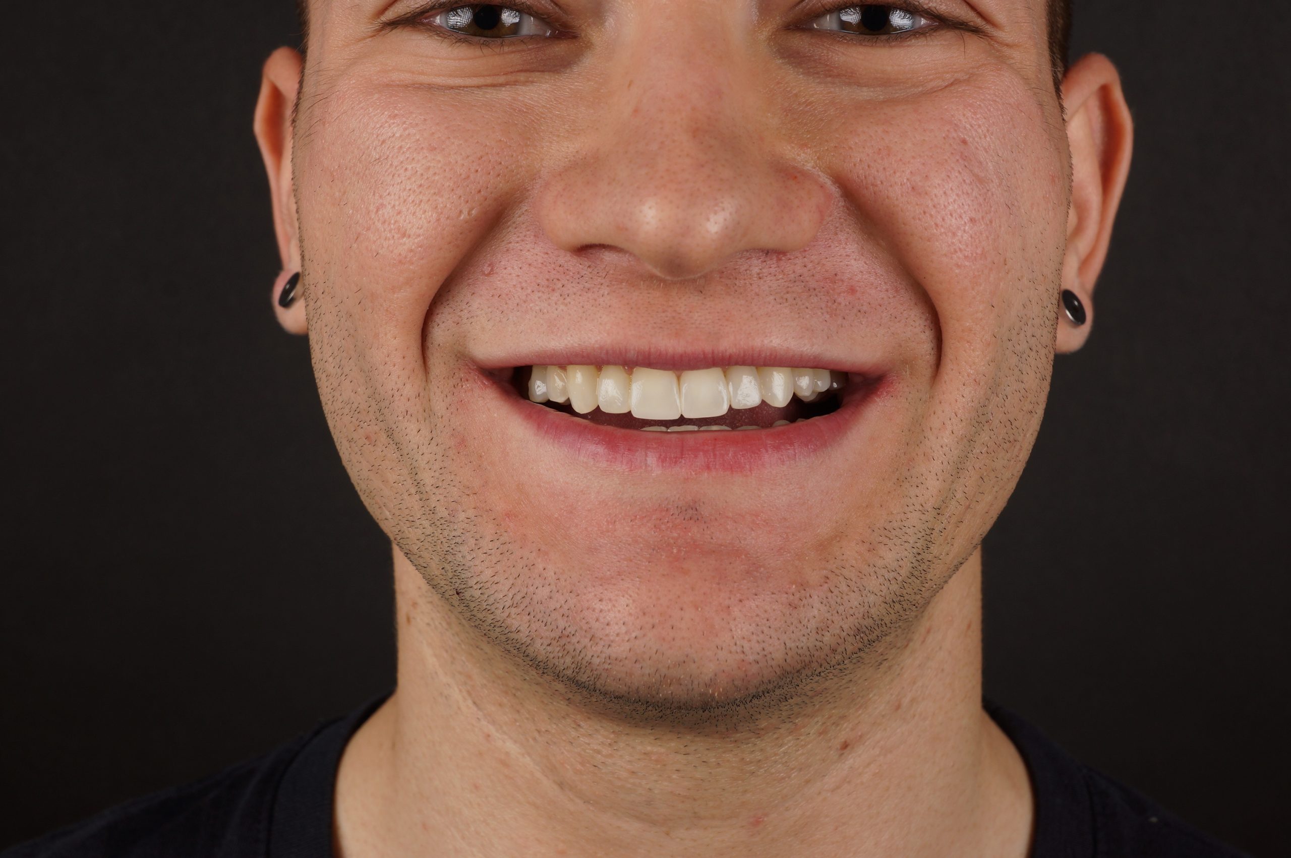 After - Crown lengthening + Philips Zoom whitening + 4 aesthetic composite reconstructions