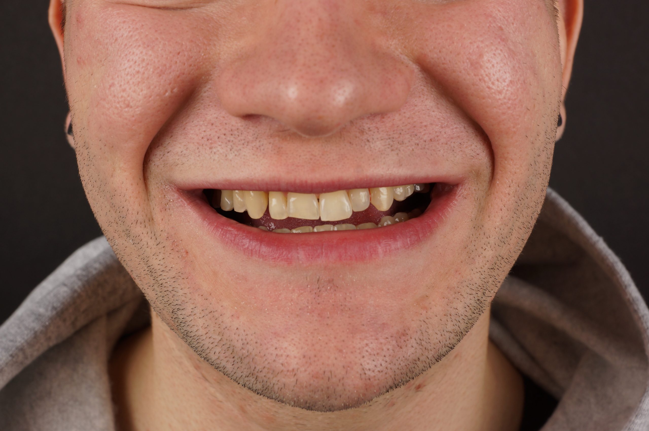 Before - Crown lengthening + Philips Zoom whitening + 4 aesthetic composite reconstructions