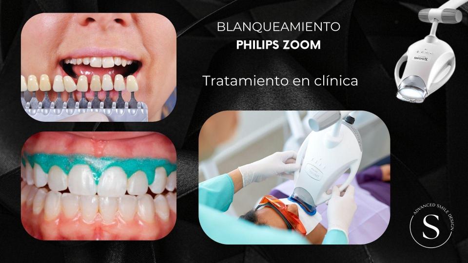 sonrisa natural y luminosa después de blanqueamiento dental profesional