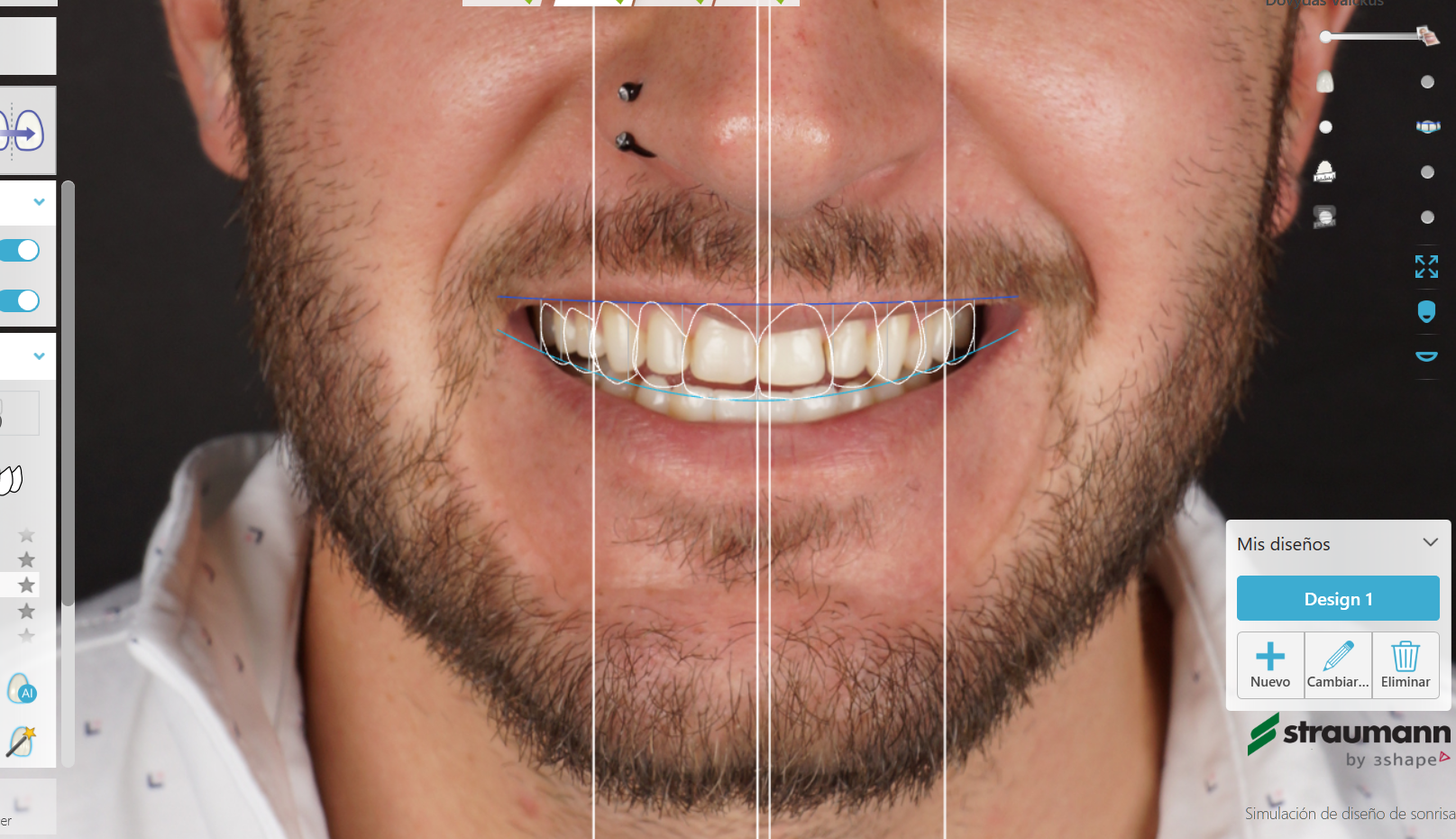 carillas dentales naturales en clínica dental SMITA Barcelona