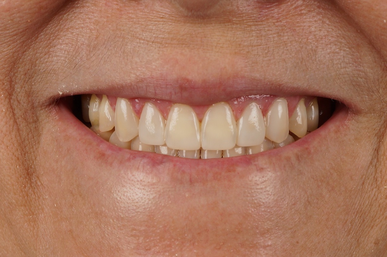 blanqueamiento dental profesional en Barcelona con resultado natural