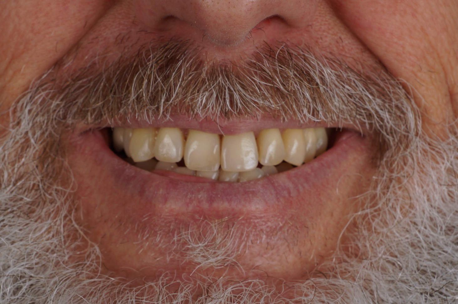 blanqueamiento previo a carillas dentales en clínica estética Barcelona