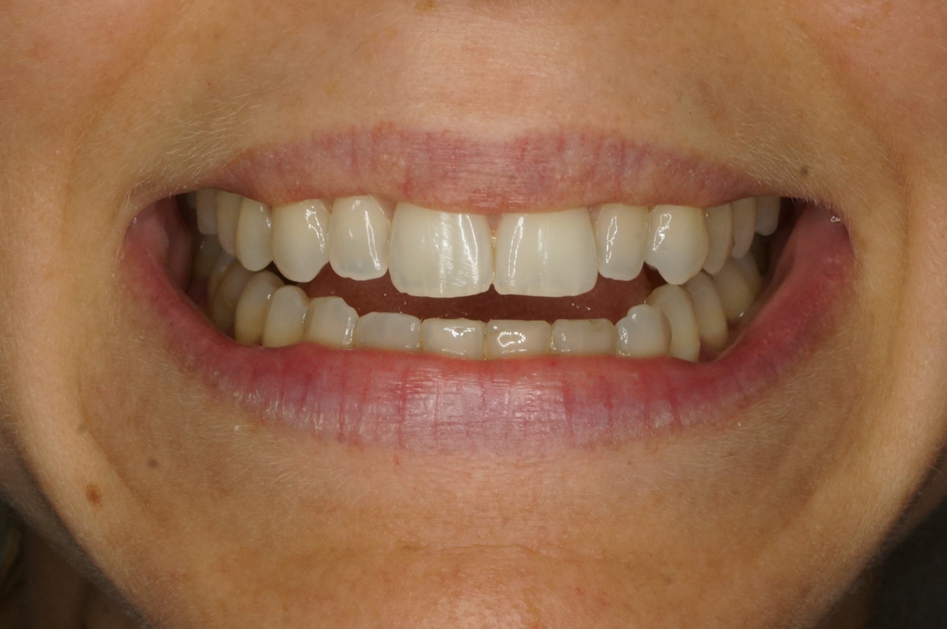 Philips Zoom whitening & 2 lateral porcelain veneers - Before